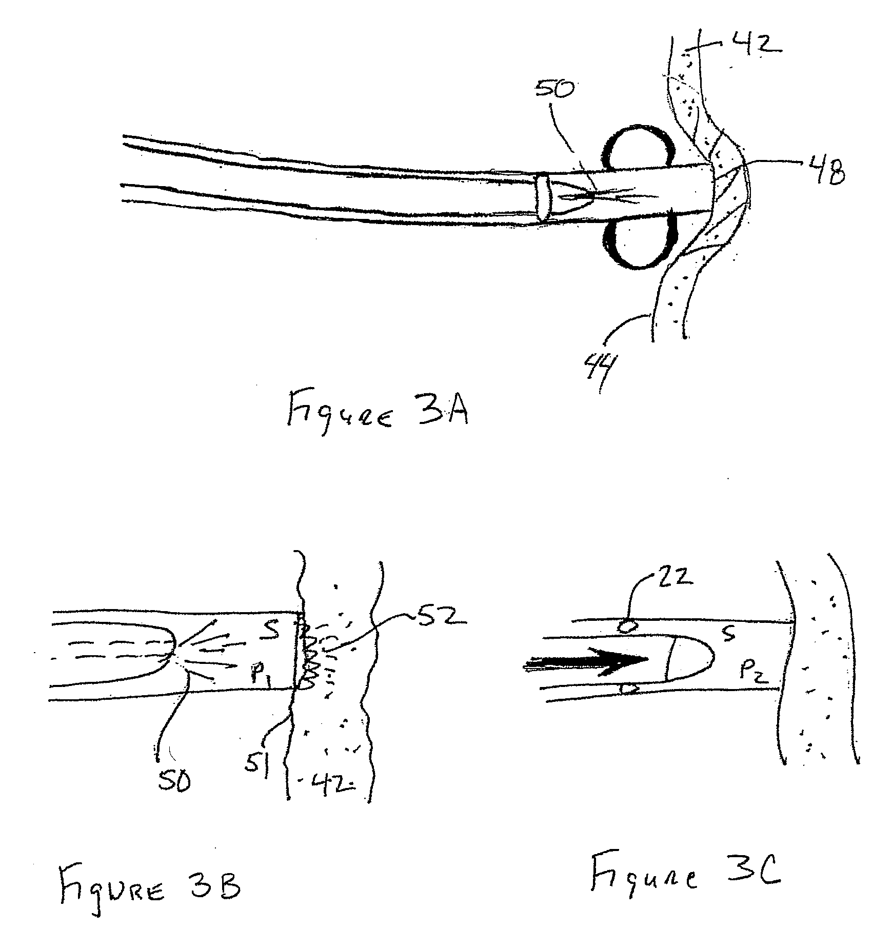 Trans Urinary Bladder Access Device and Method
