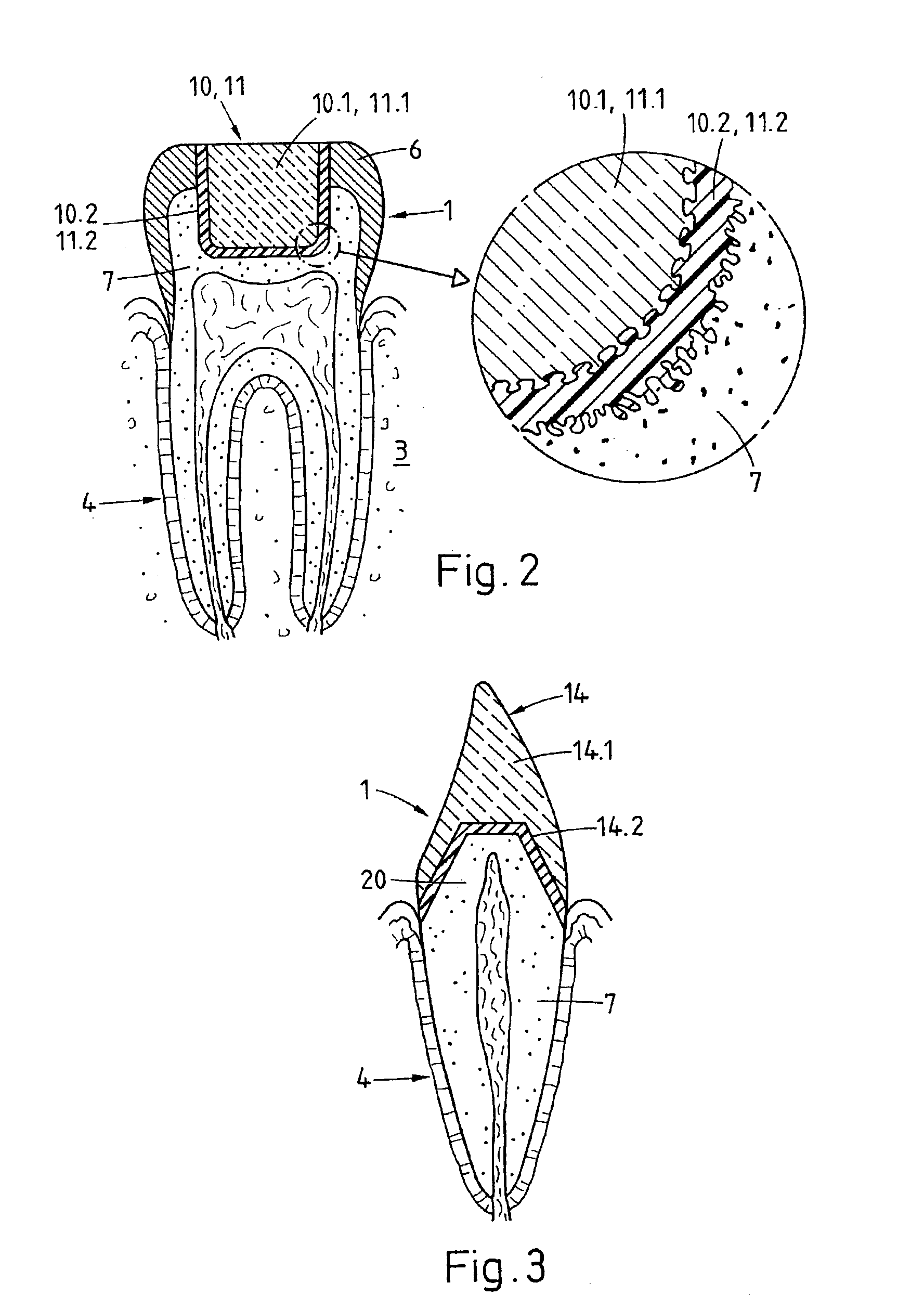 Preparation for being fastened on a natural tooth part or tooth and corresponding fastening method