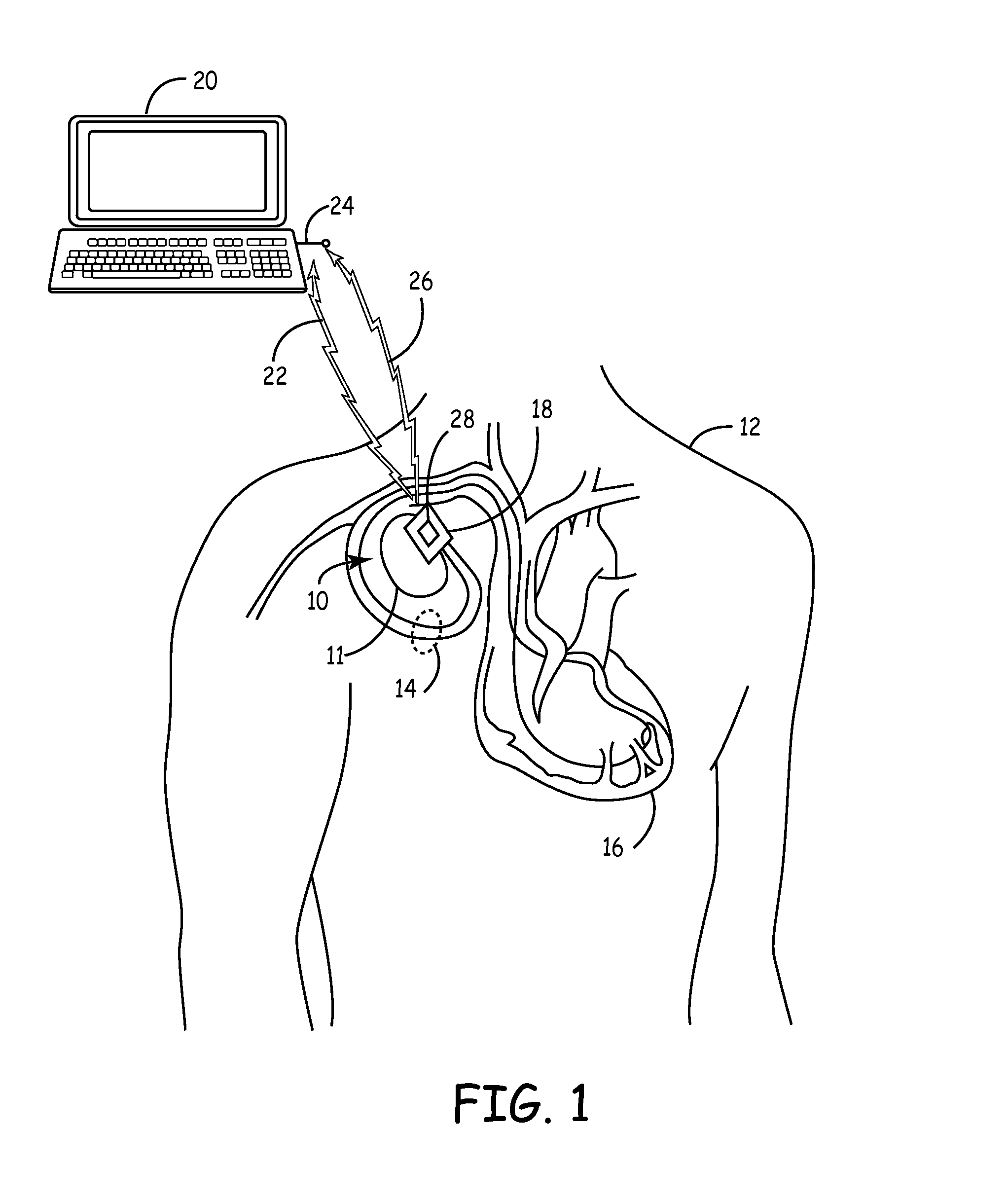 Implantable medical device package antenna