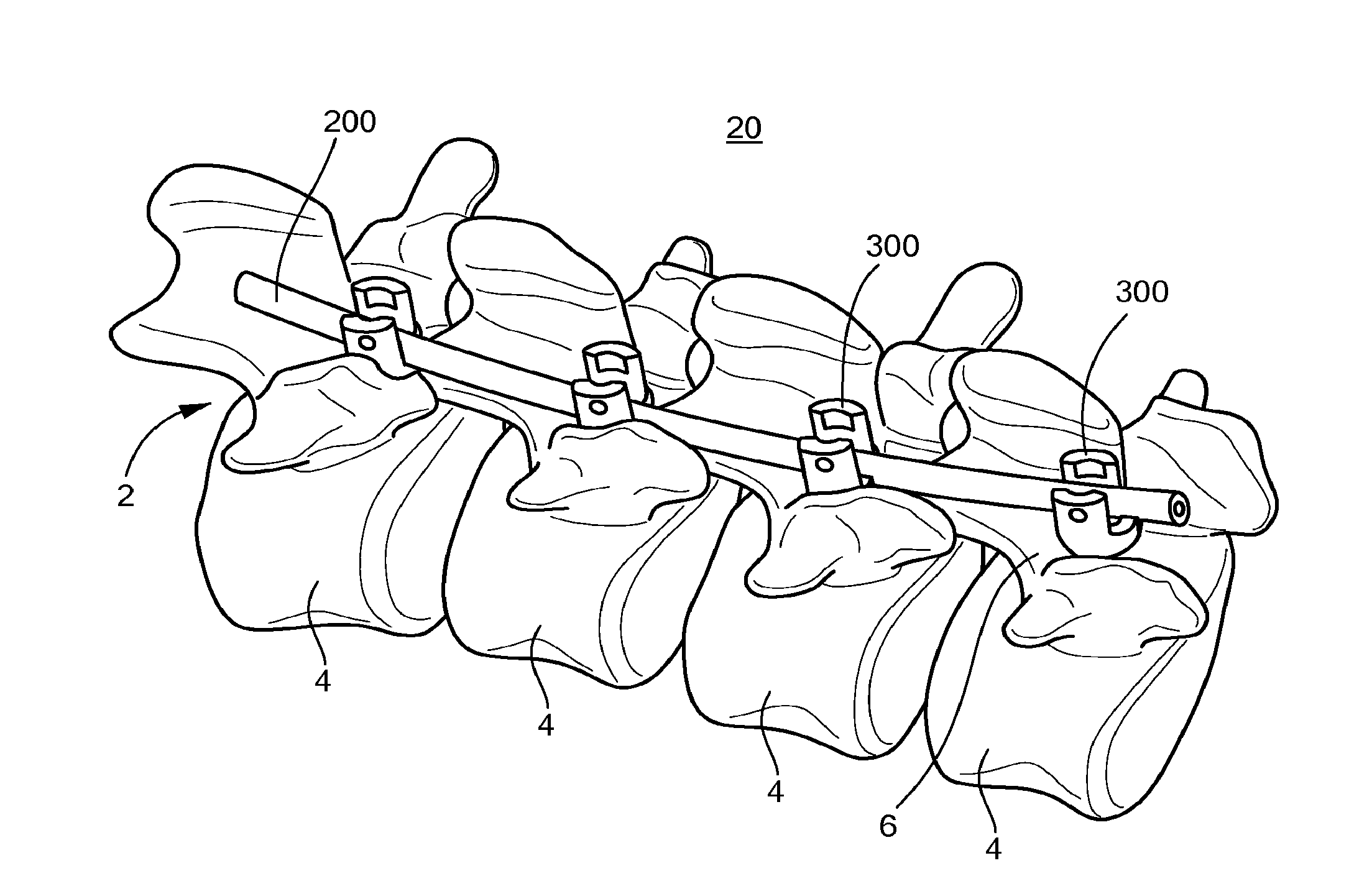 Minimally invasive spinal stabilization system