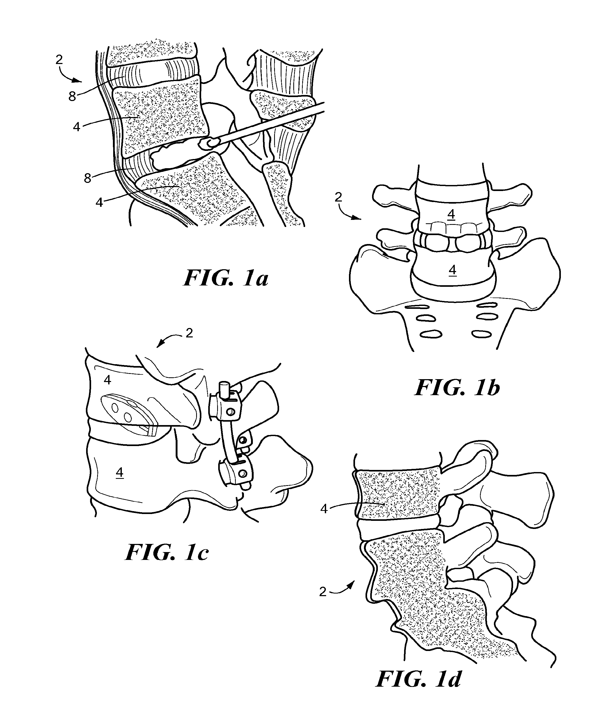 Minimally invasive spinal stabilization system