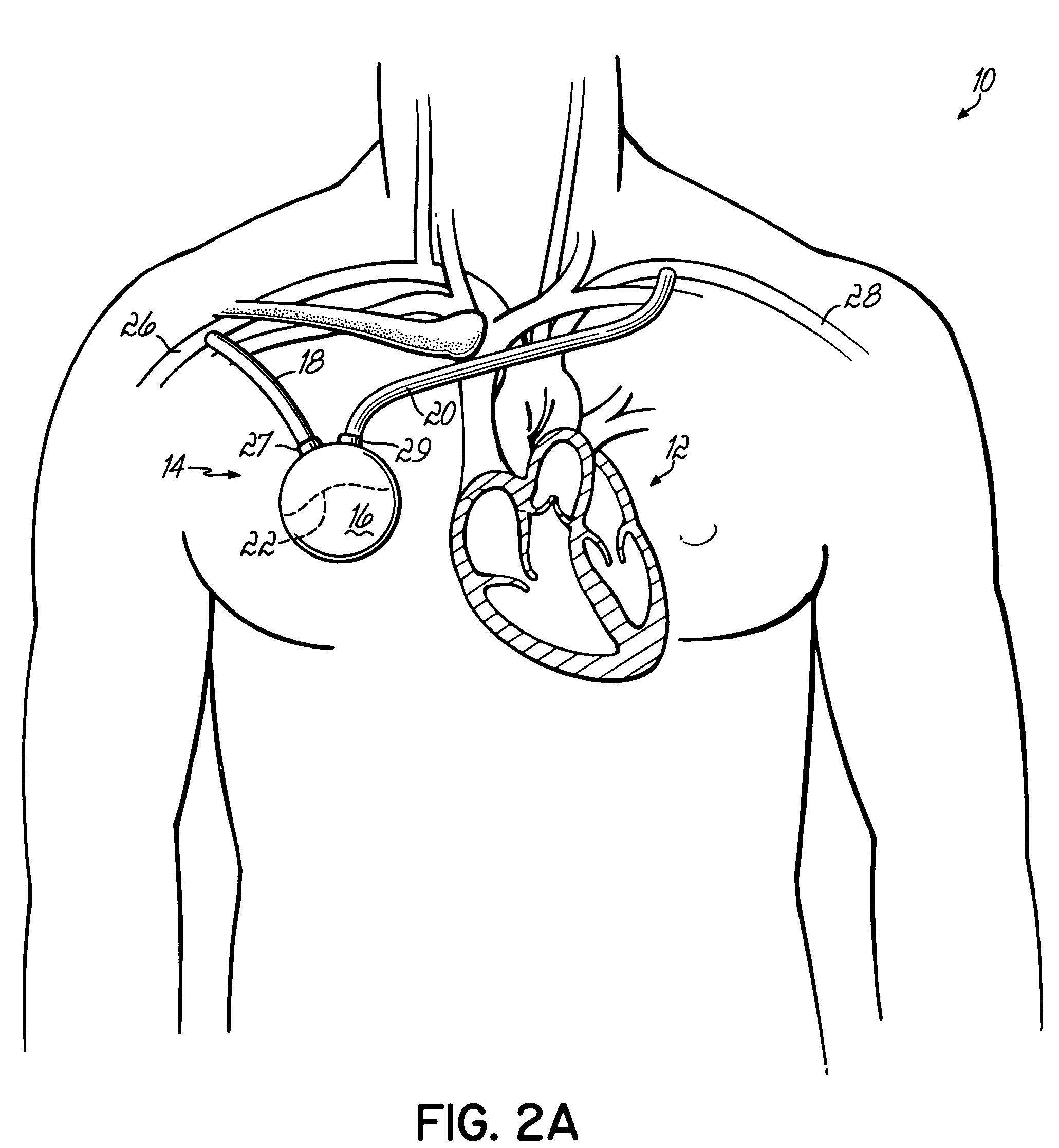 Methods, devices and systems for counterpulsation of blood flow to and from the circulatory system