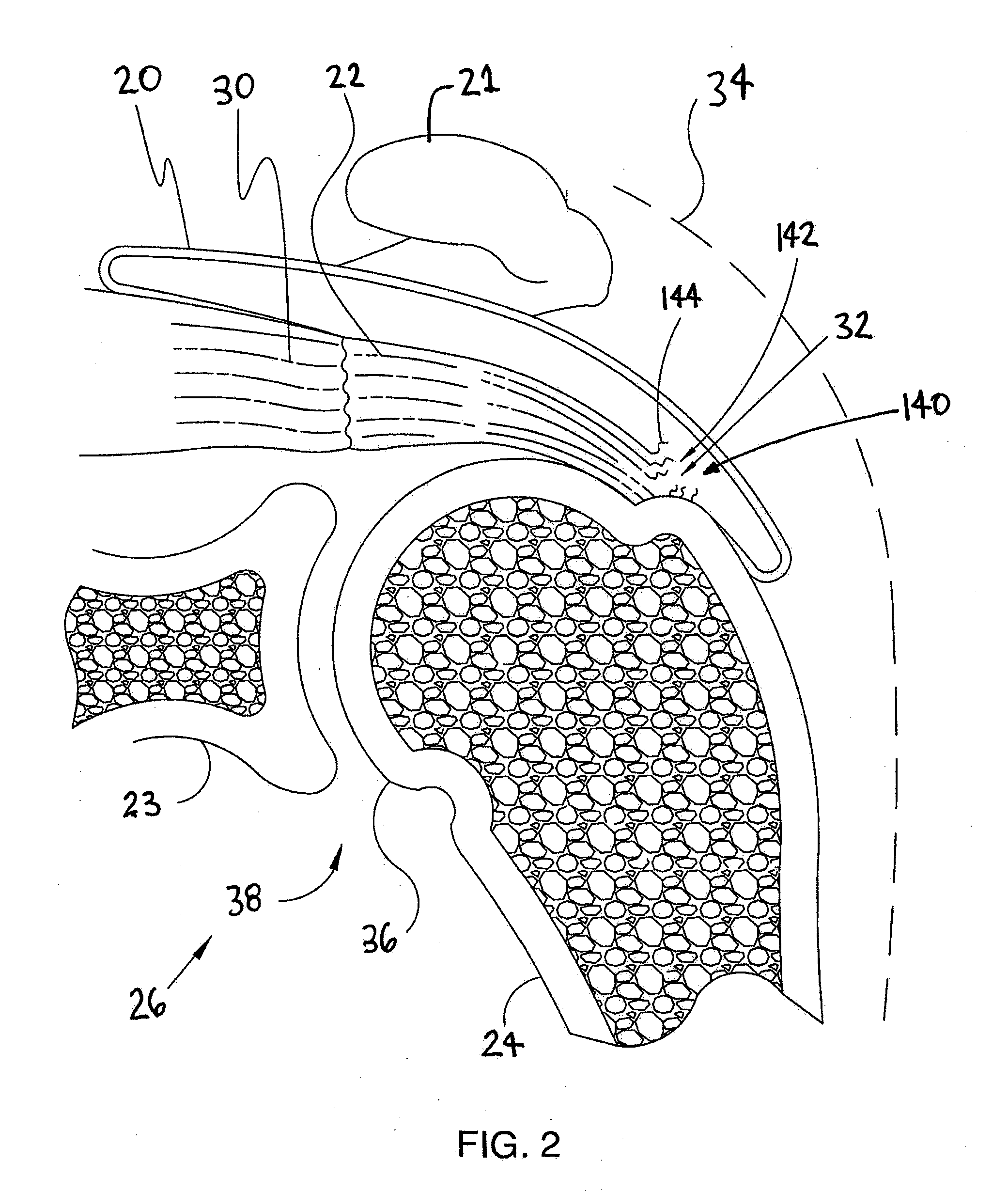 Implantable tendon protection systems and related kits and methods