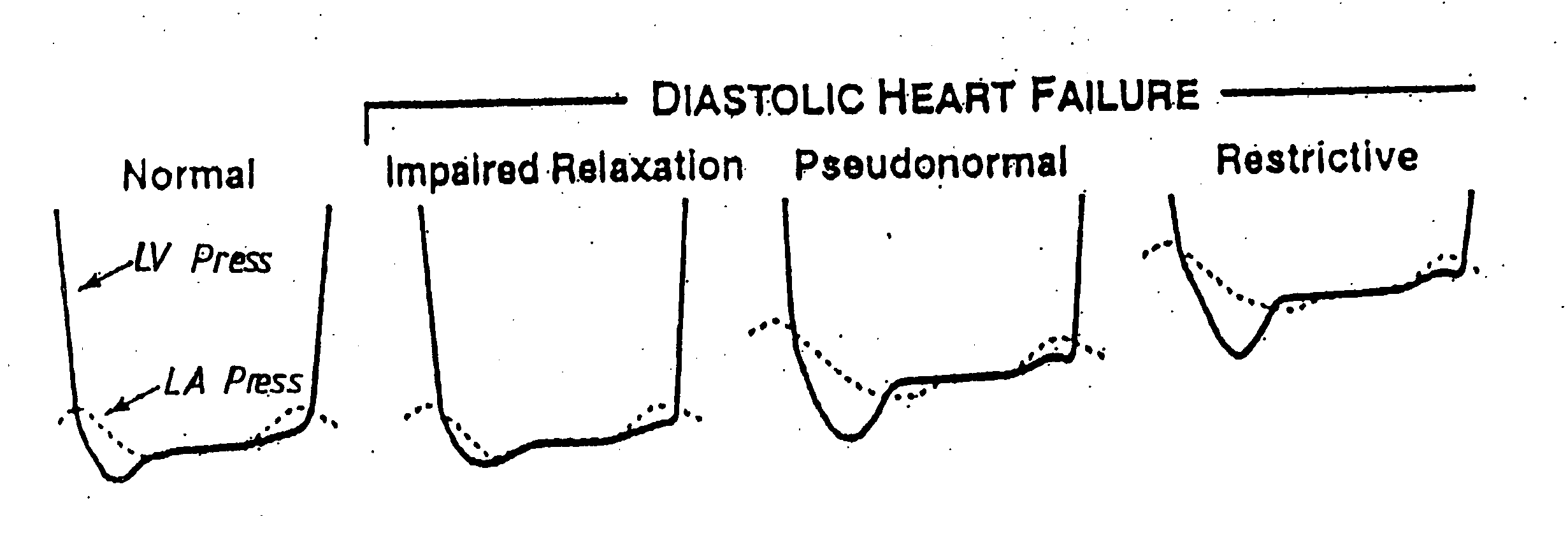 Apparatus for detecting diastolic heart failure