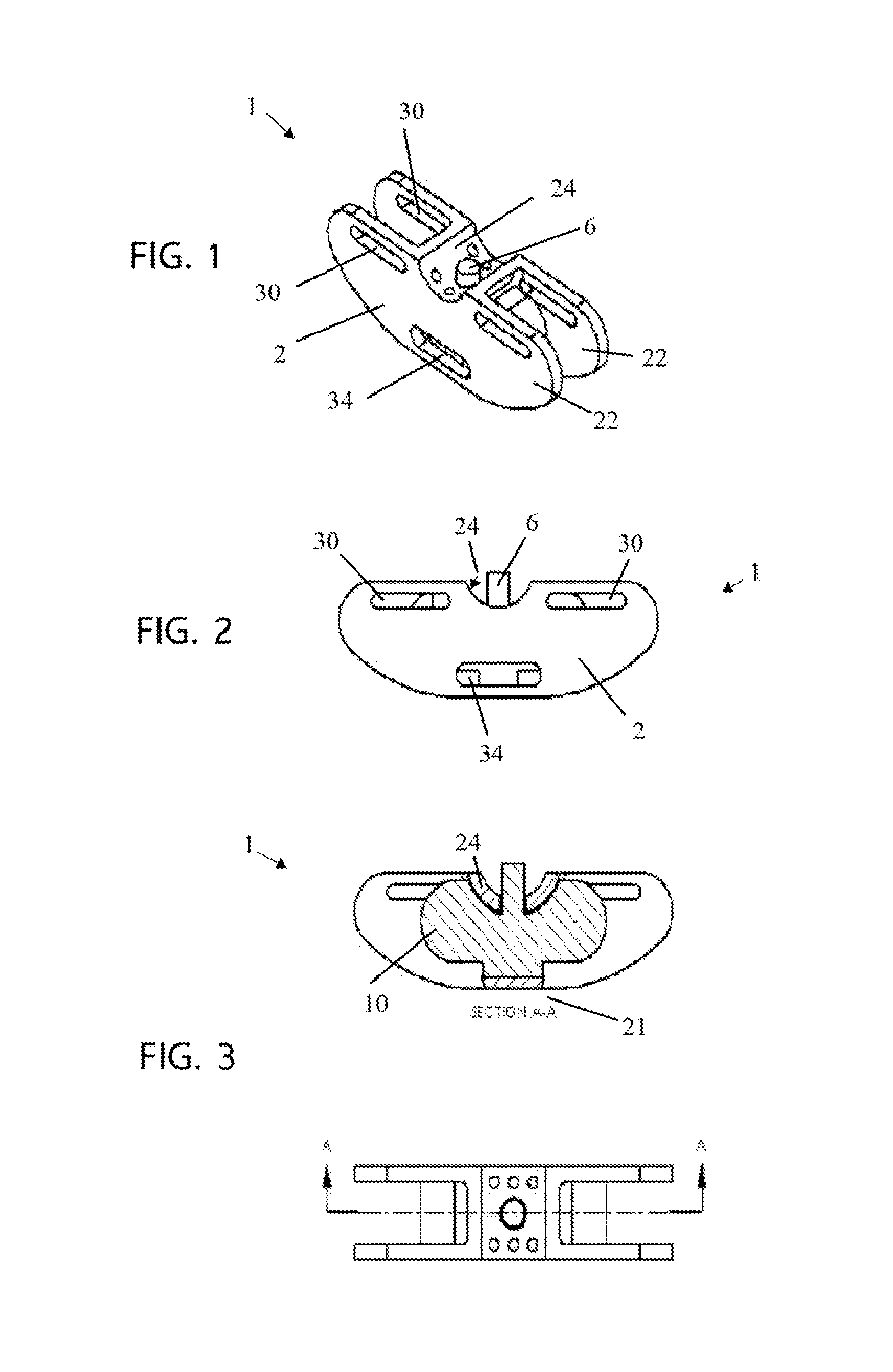 Dynamic Inter-Spinous Process Spacer