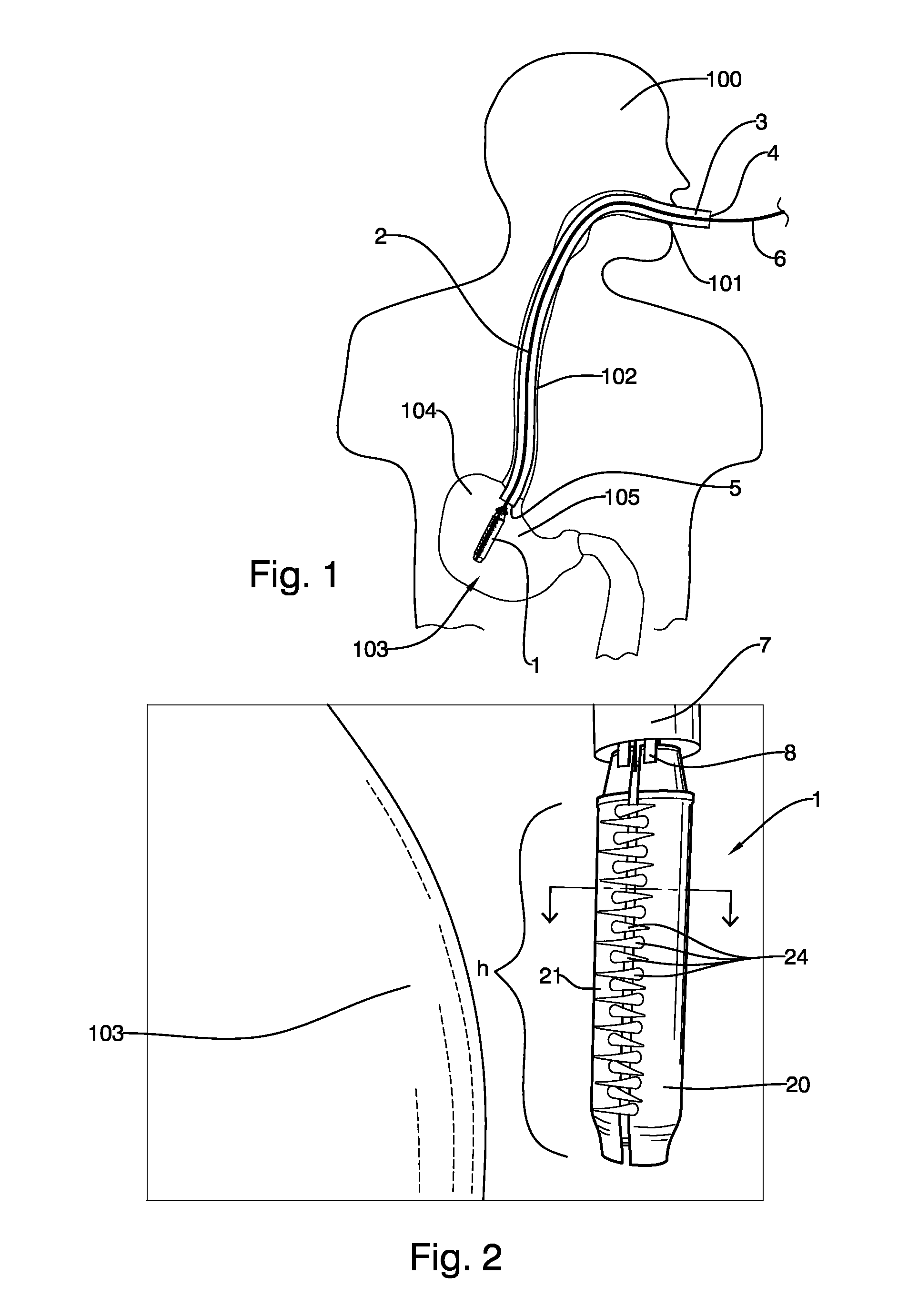 Endoscopic implantable device and method for the apposition of the stomach walls for reducing the stomach internal volume in a weight loss surgery procedure