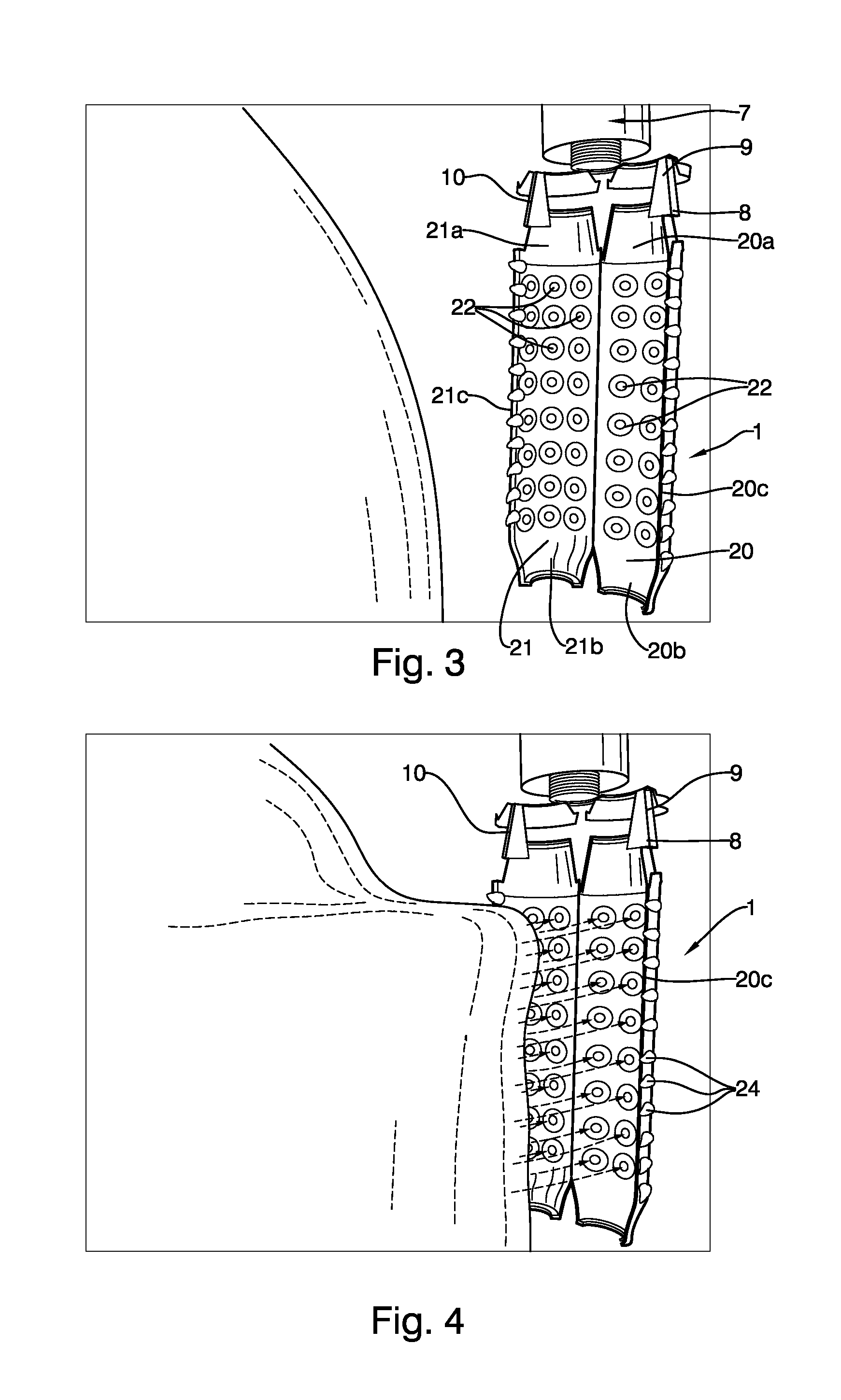 Endoscopic implantable device and method for the apposition of the stomach walls for reducing the stomach internal volume in a weight loss surgery procedure