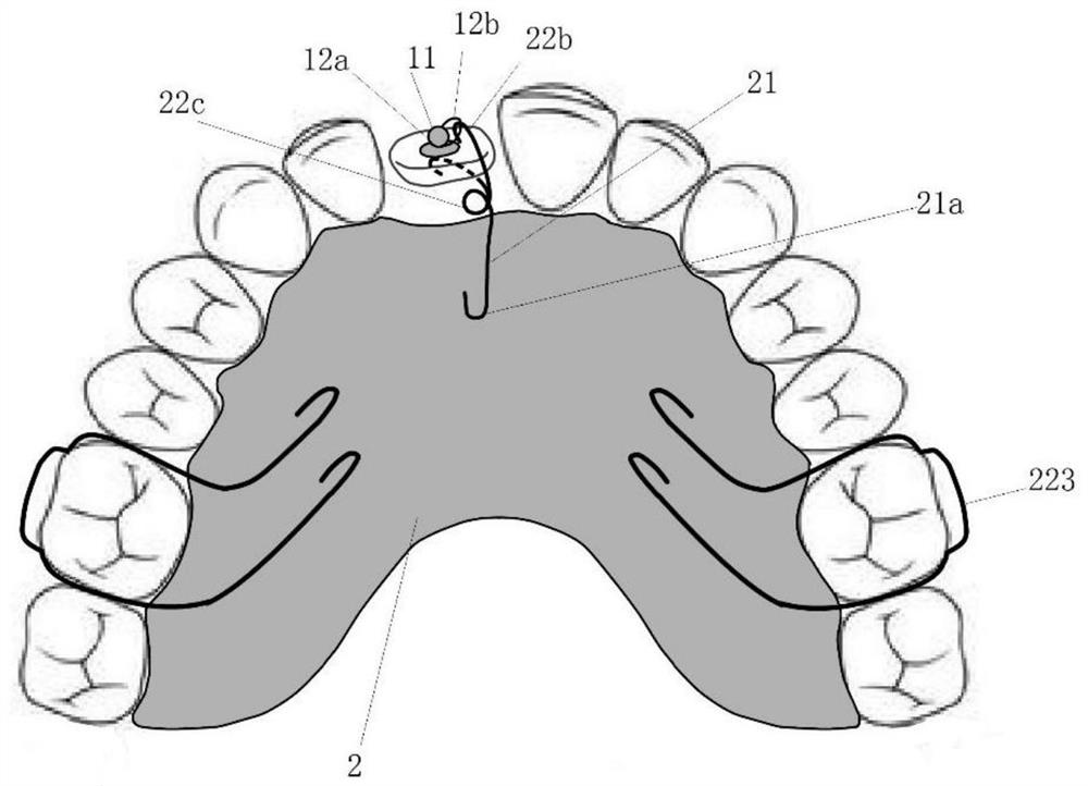 Embedded tooth traction device