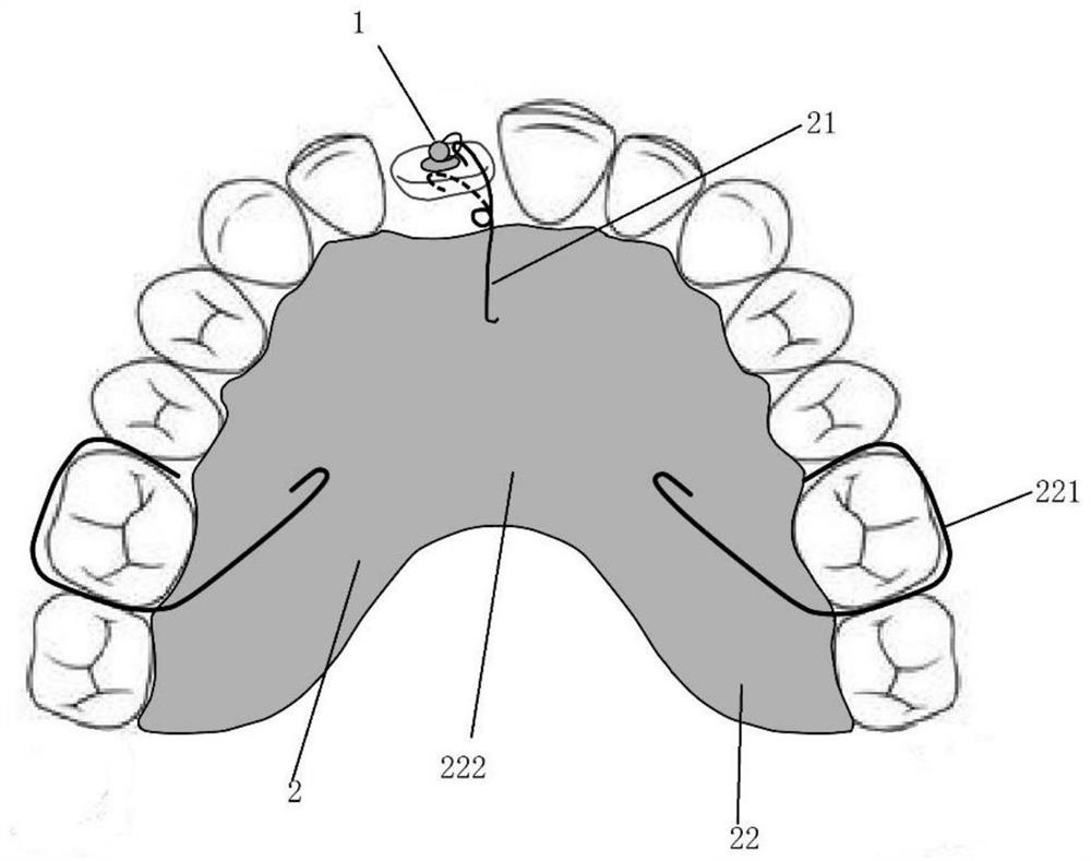 Embedded tooth traction device