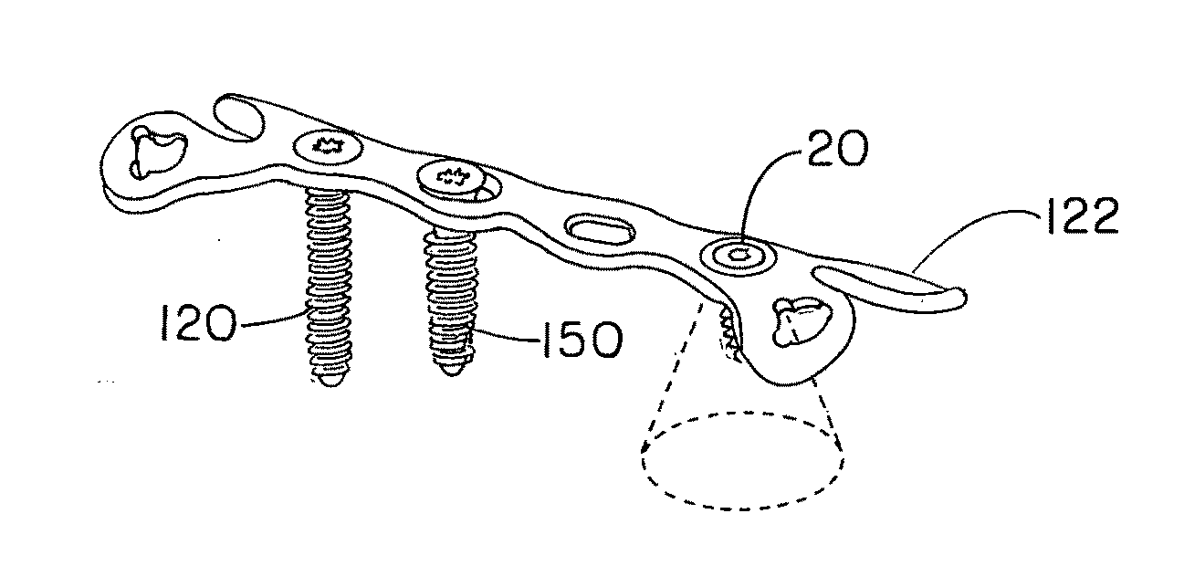 System for achieving selectable fixation in an orthopedic plate