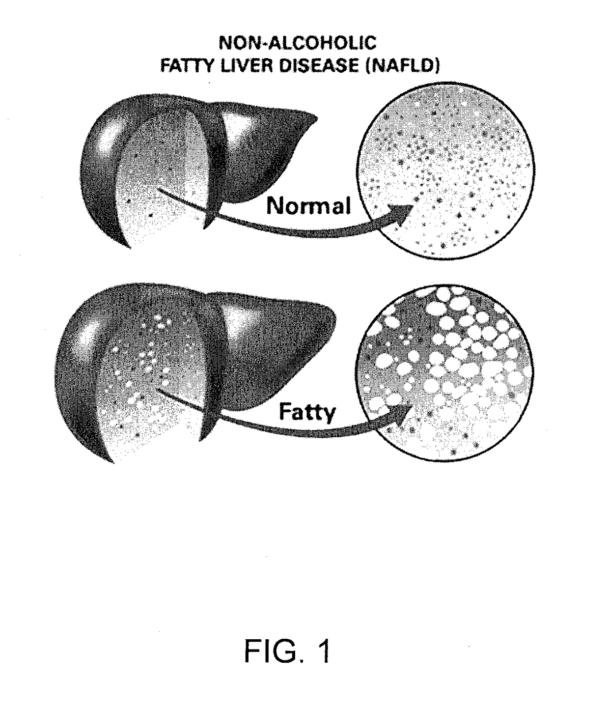 Method and System for Treating Non-Alcoholic Fatty Liver Disease