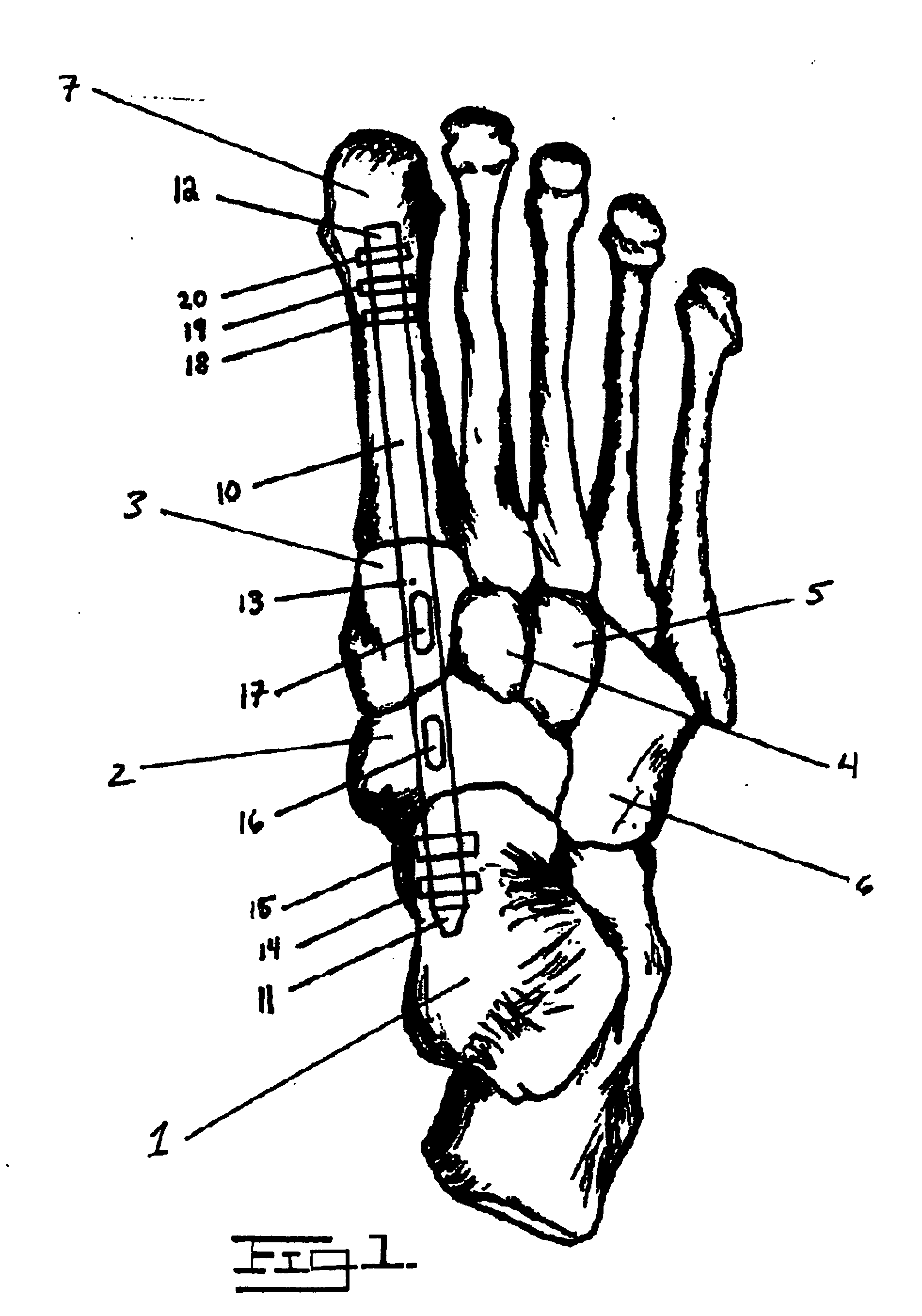 Method and apparatus for repairing the mid-food region via an intramedullary nail