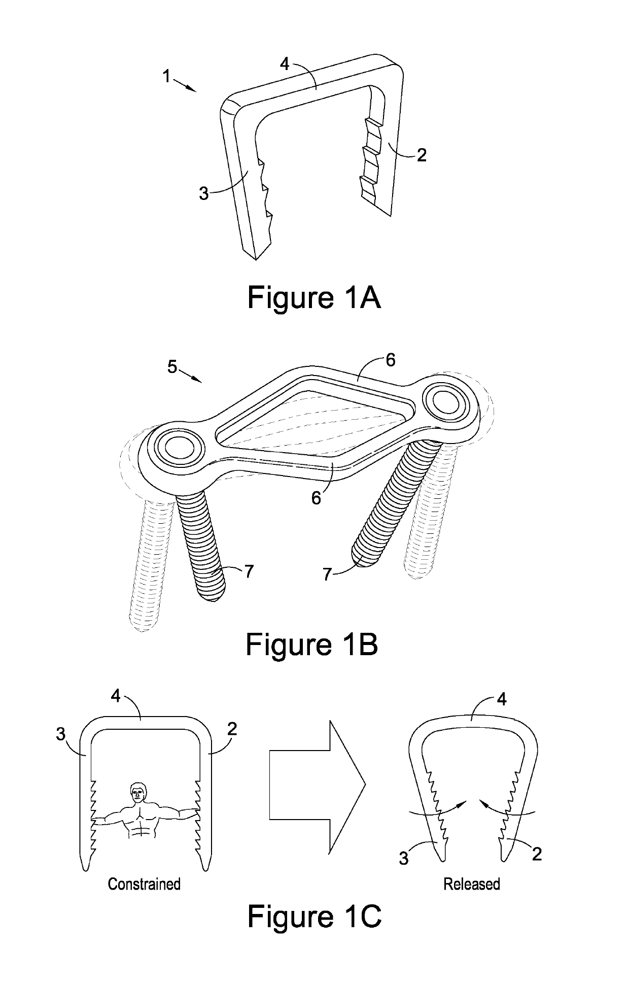 Bone ties and staples for use in orthopaedic surgery