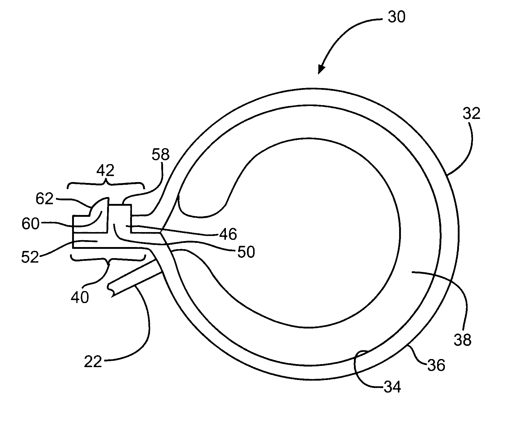 Implantable band with attachment mechanism