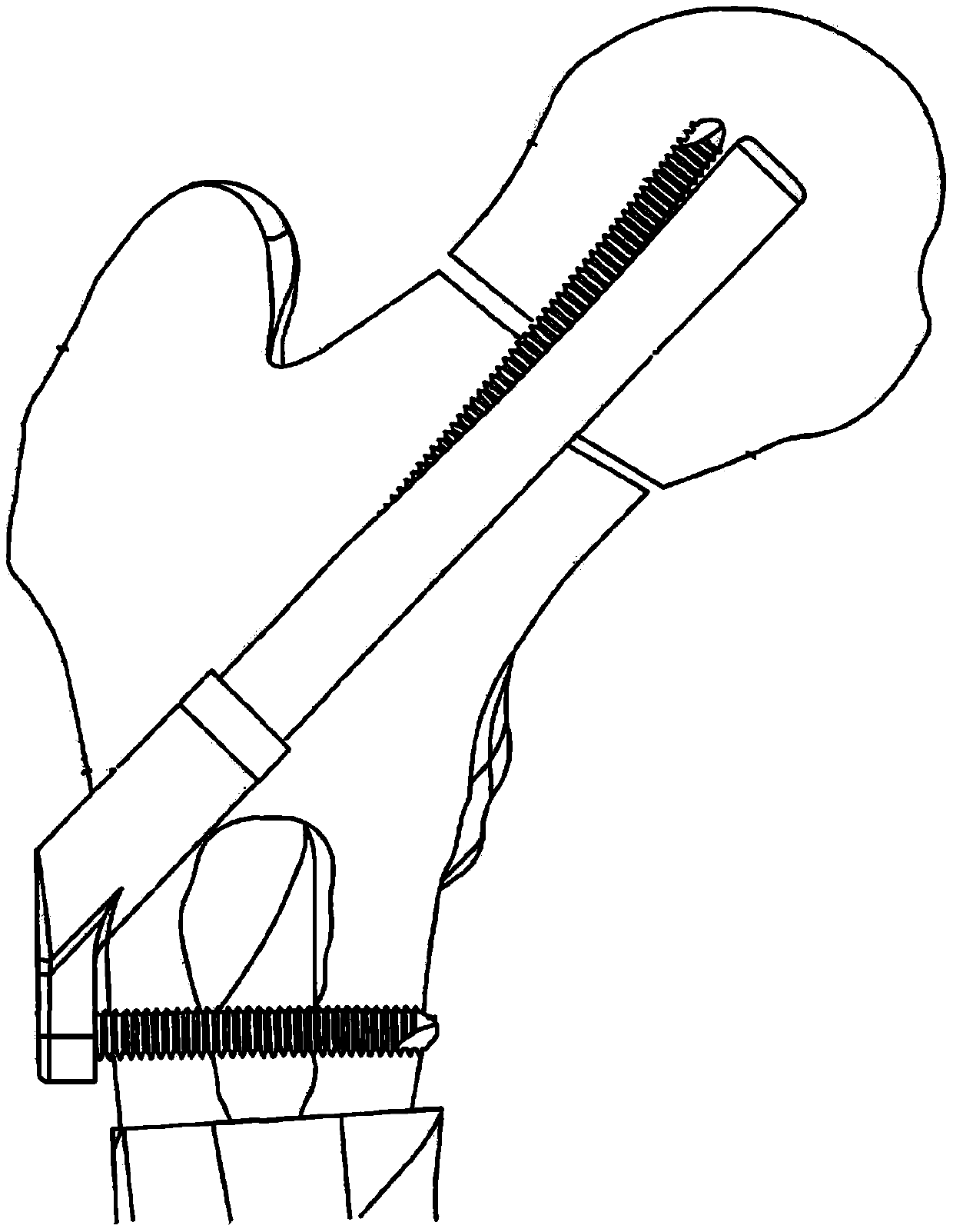 Bone fixation system