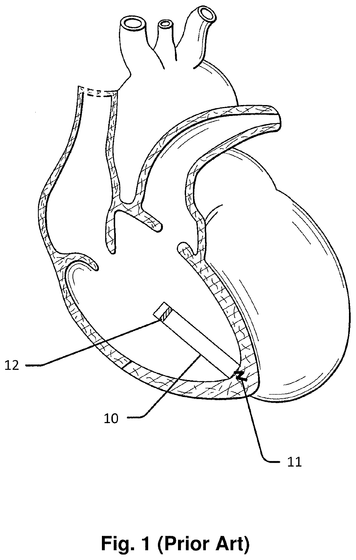 Leadless multi-electrode cardiac pacemakers and methods of implantation thereof