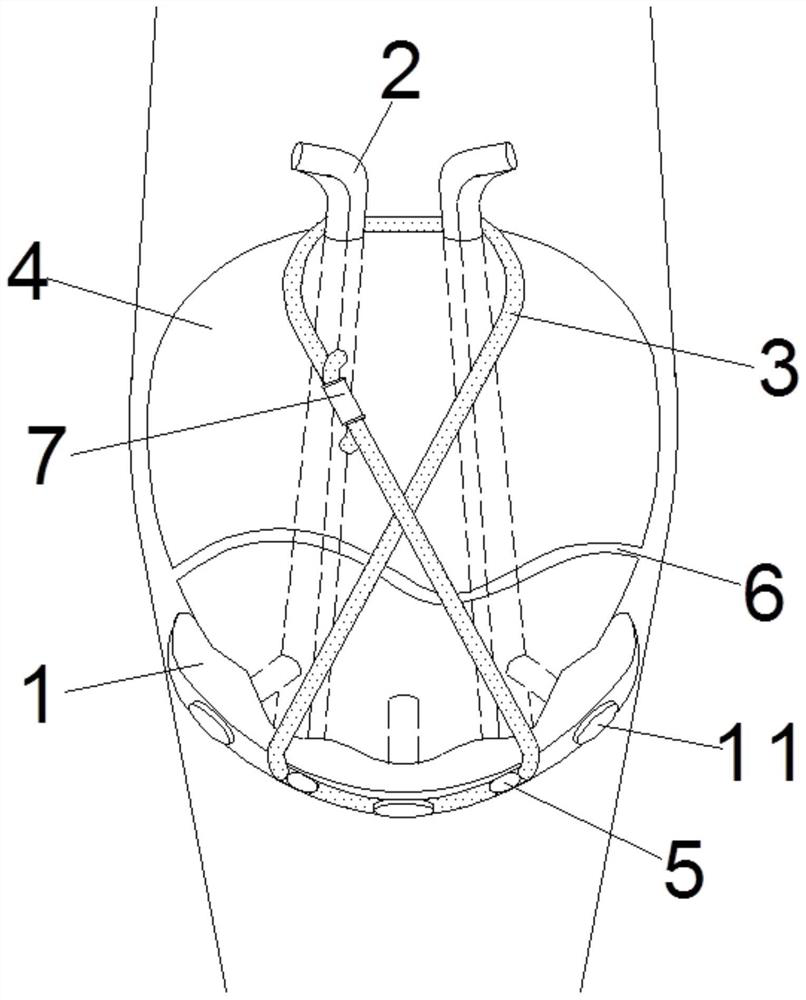 Combined fixing device for patella distal extra-articular fracture