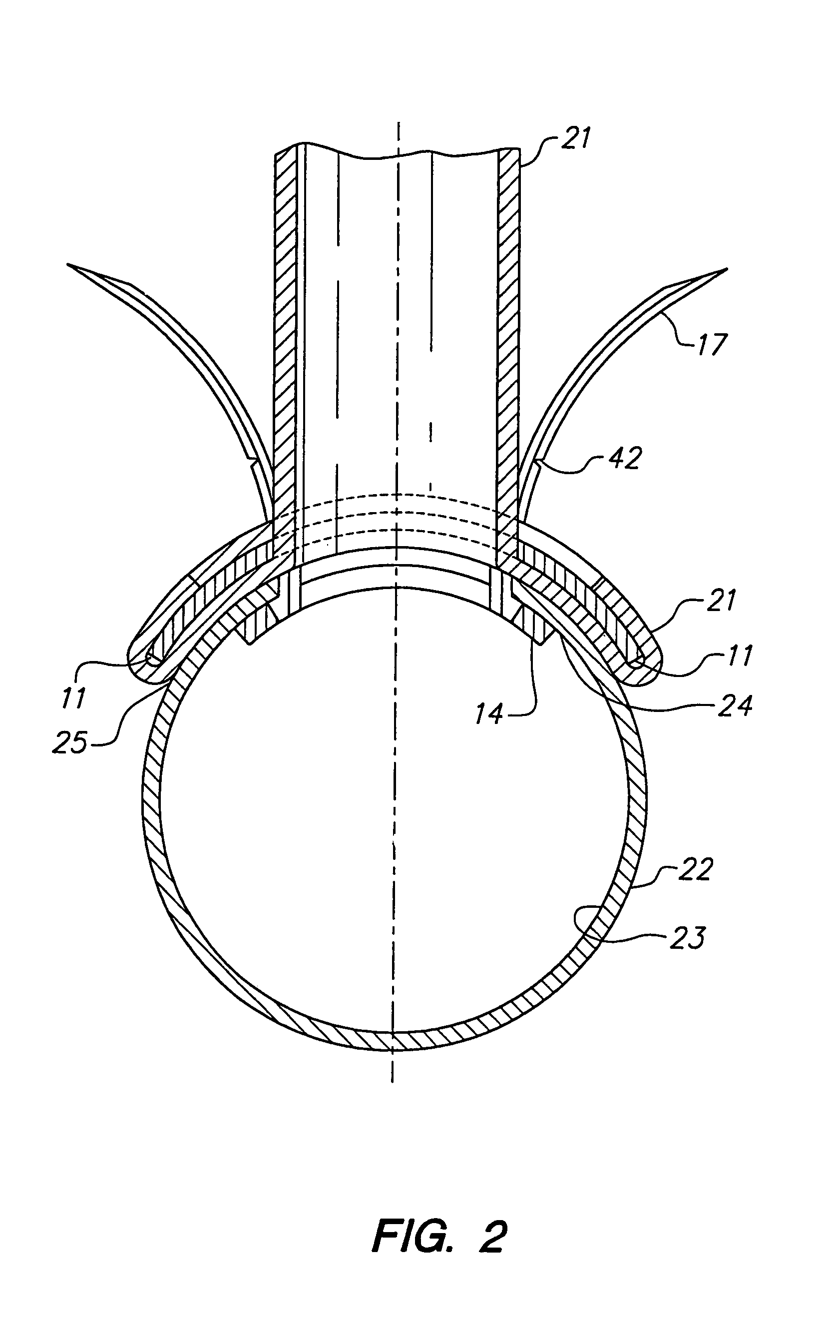 Method and system for attaching a graft to a blood vessel