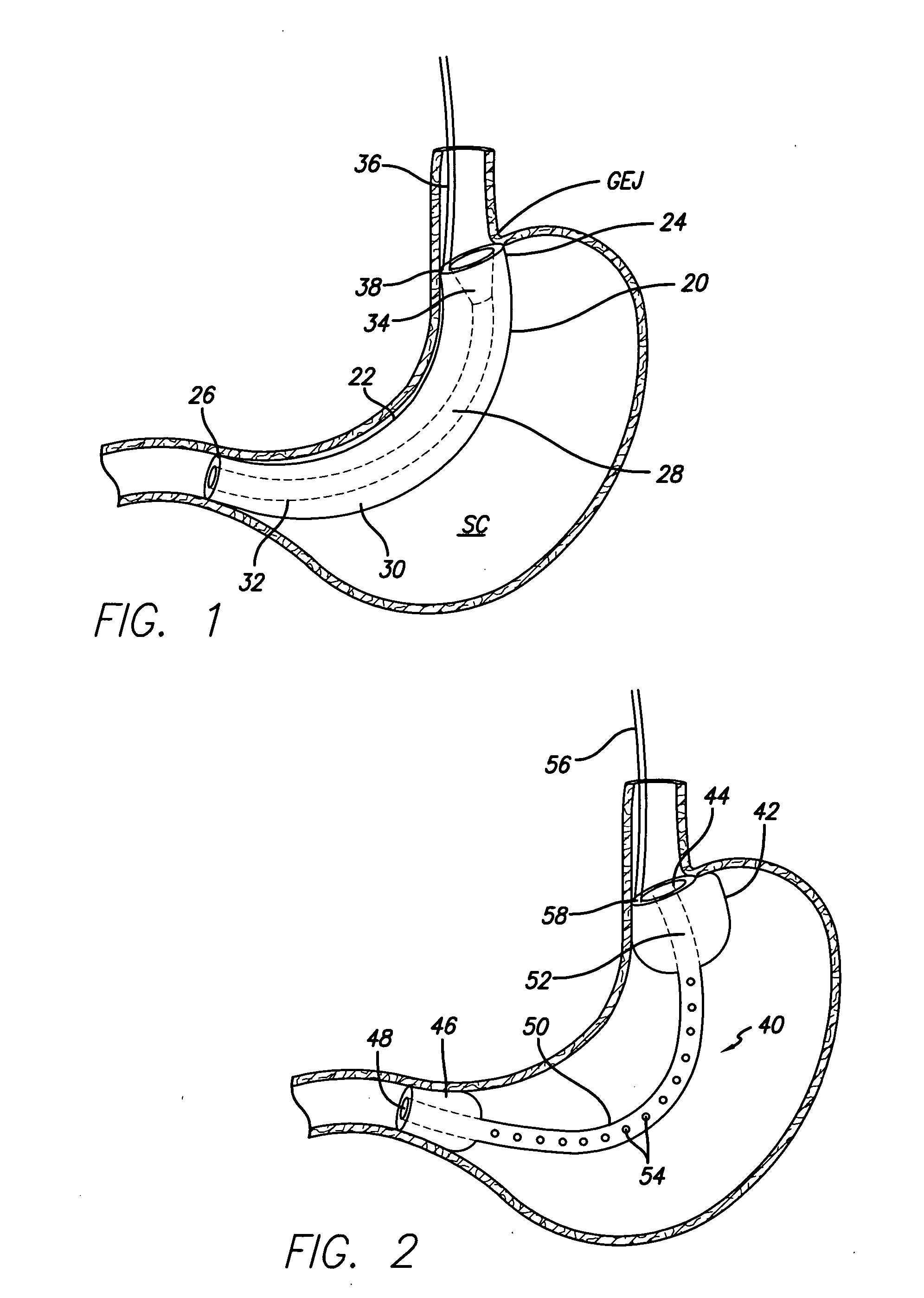Systems and methods for treating obesity