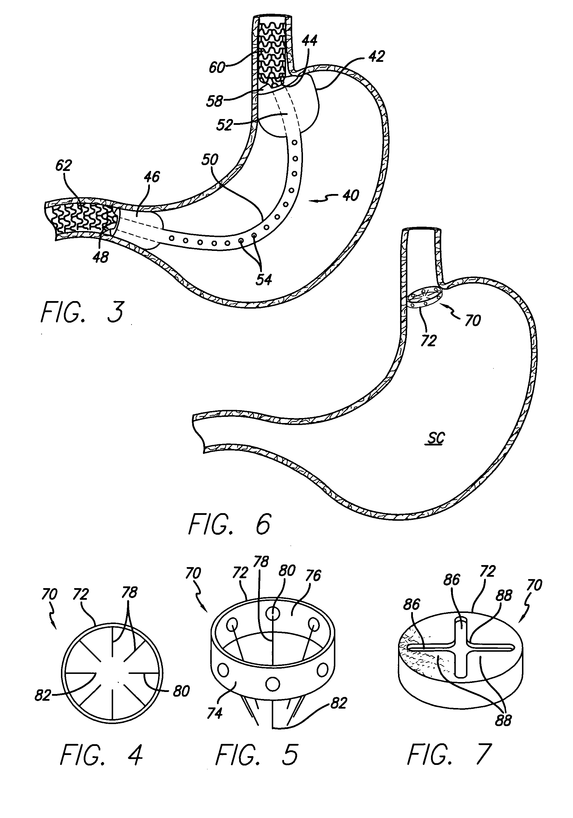 Systems and methods for treating obesity
