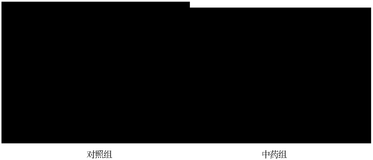 Traditional Chinese medicine composition for preventing and treating precancerous lesions of liver and liver cancer, and preparation method thereof