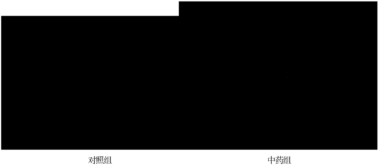 Traditional Chinese medicine composition for preventing and treating precancerous lesions of liver and liver cancer, and preparation method thereof