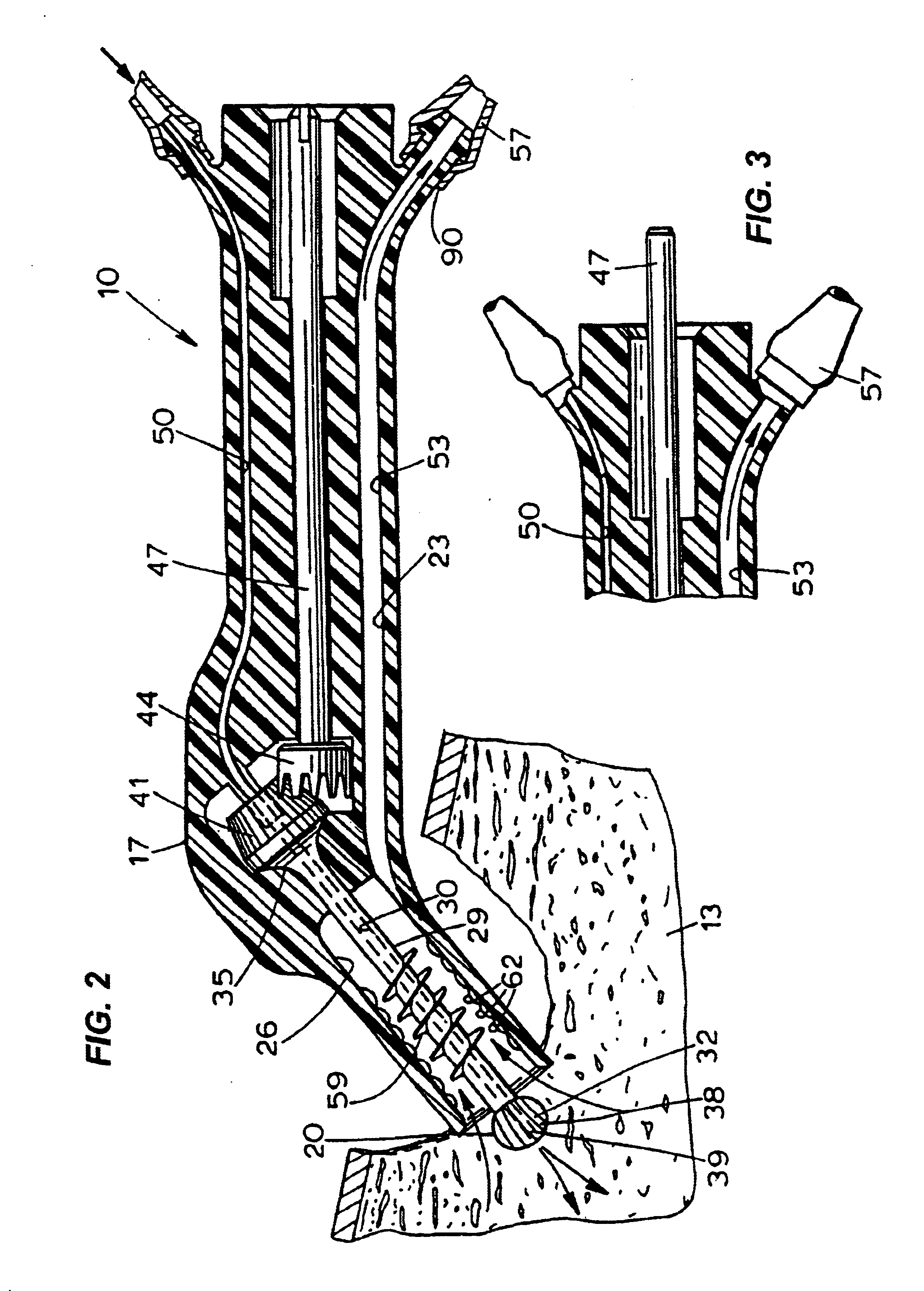 Method and apparatus for extracting bone marrow