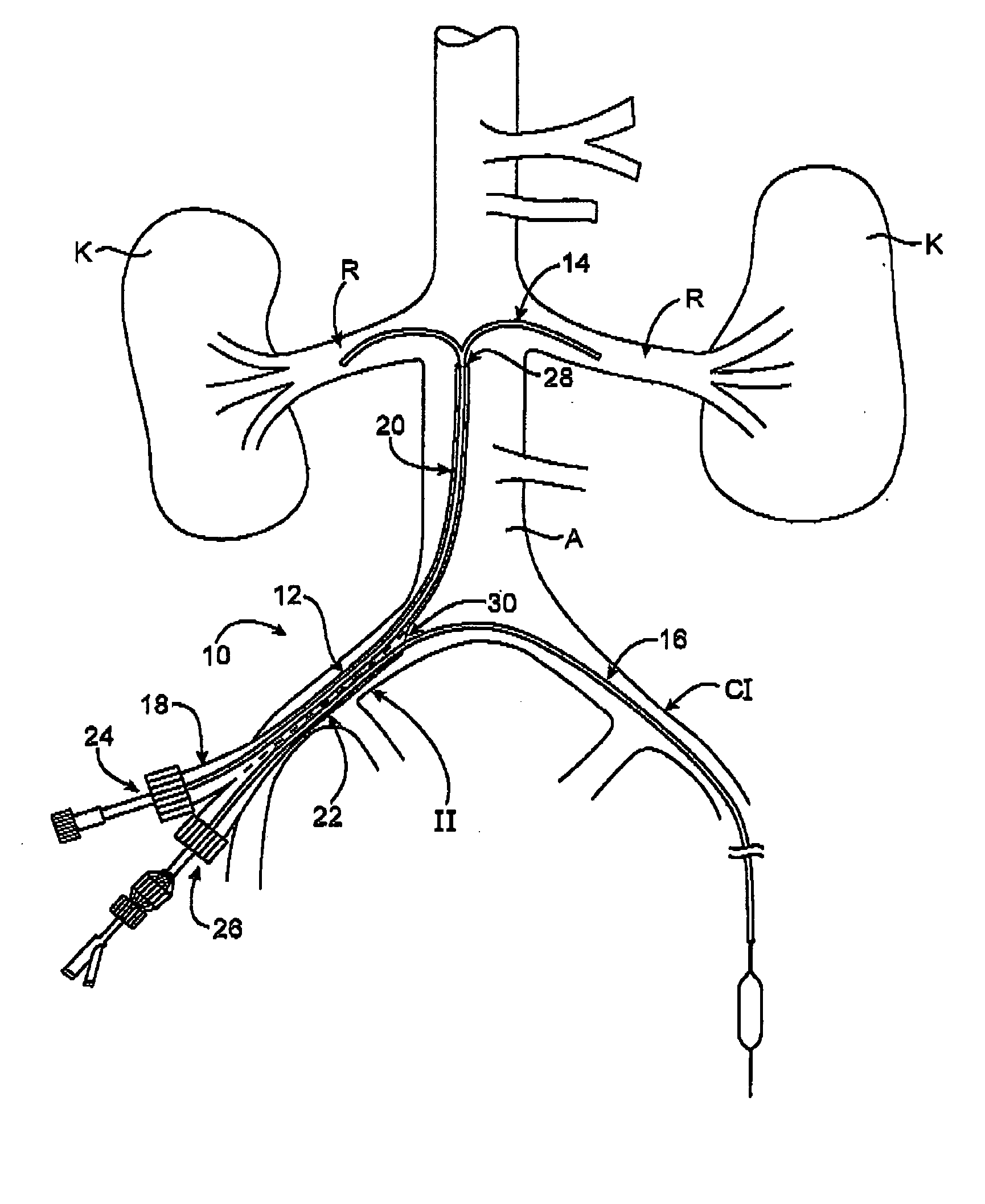 Sheath for use in peripheral interventions