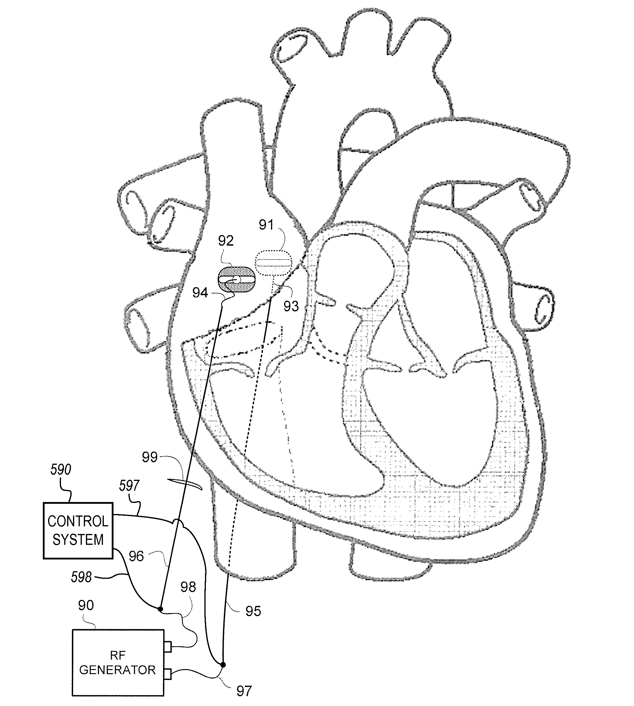 Magnetically coupling devices for mapping and/or ablating