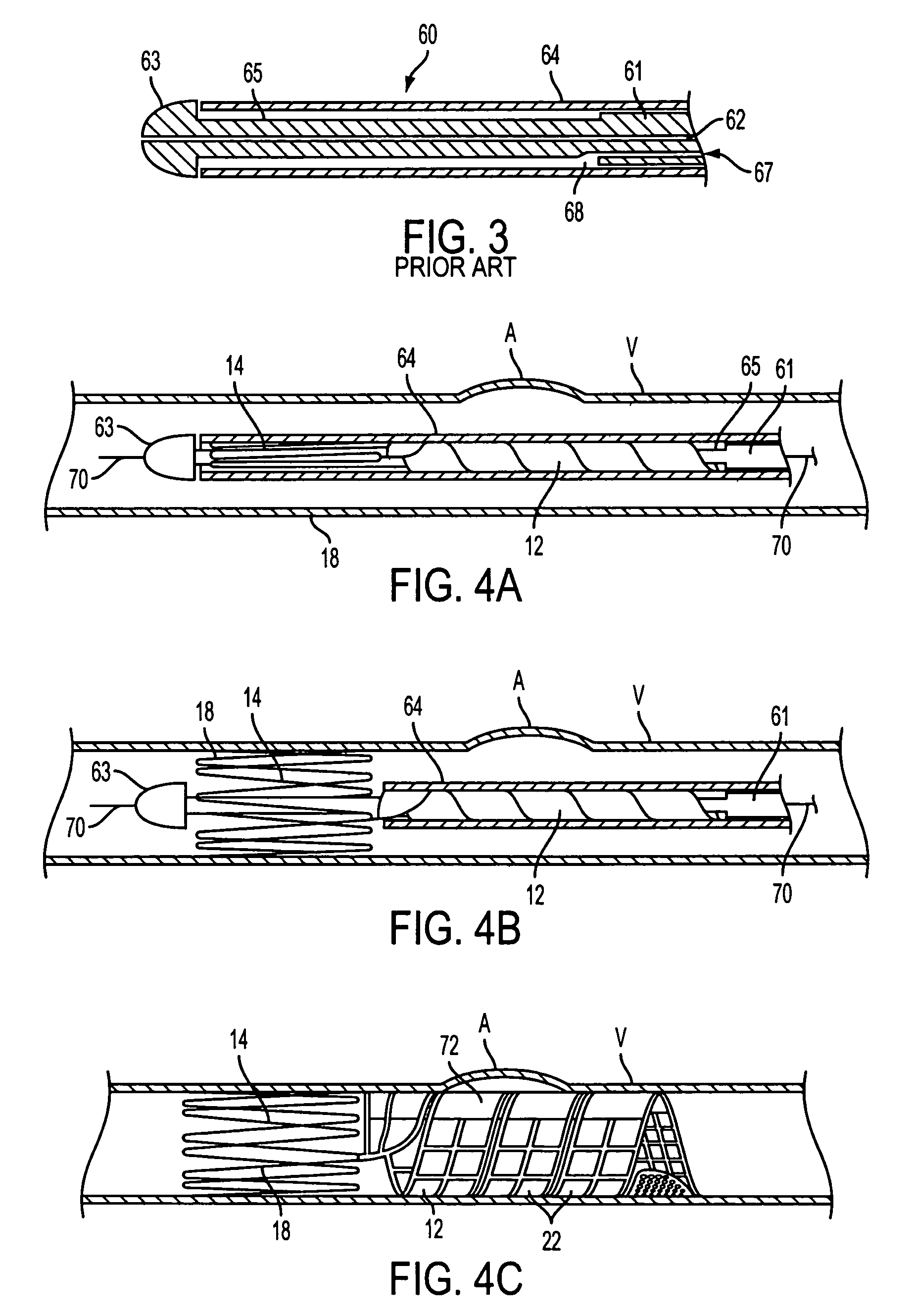 Delivery catheter for ribbon-type prosthesis and methods of use