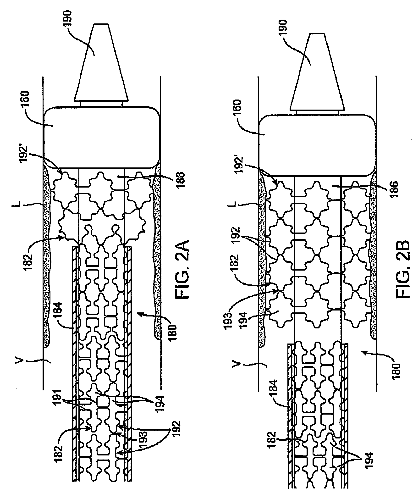 Custom-length self-expanding stent delivery systems with stent bumpers