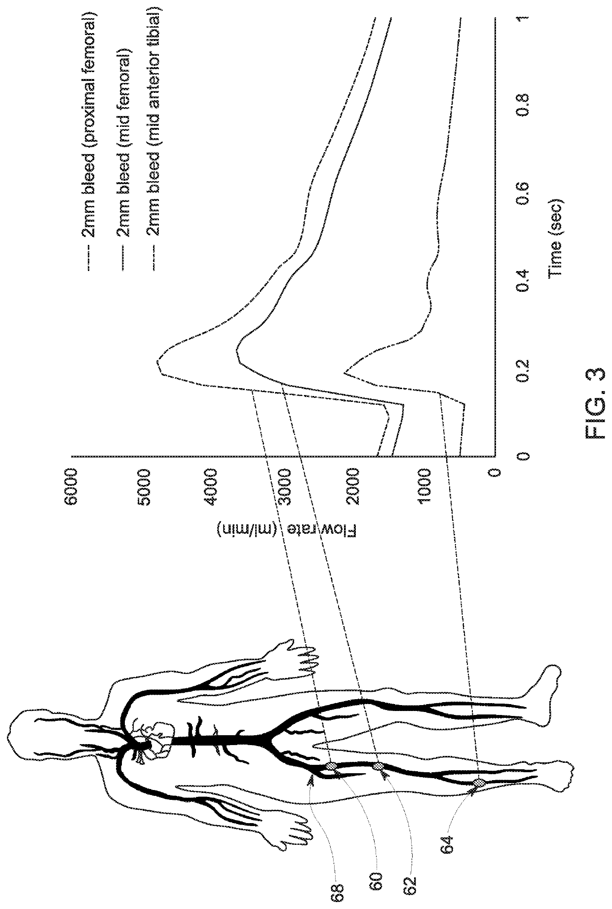 Localization of bleeding