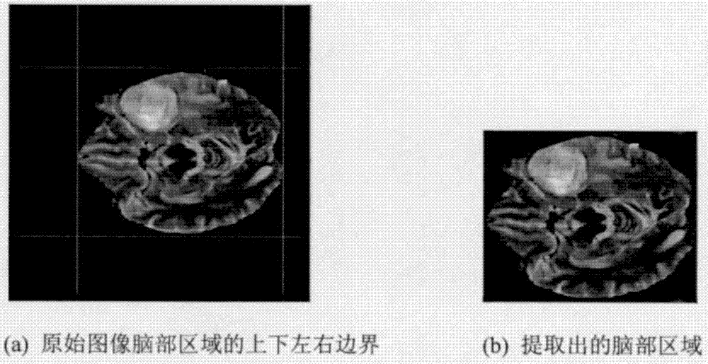 Fully convolutional network based brain MRI tumor segmentation method
