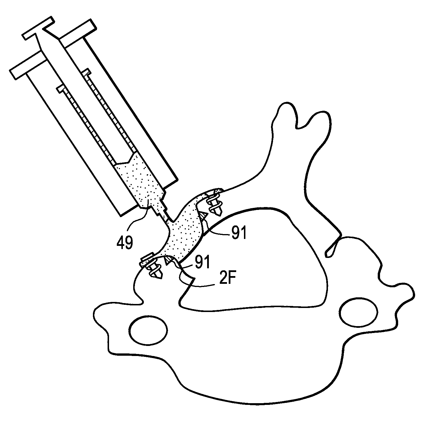 Methods and devices for expanding a spinal canal using balloons