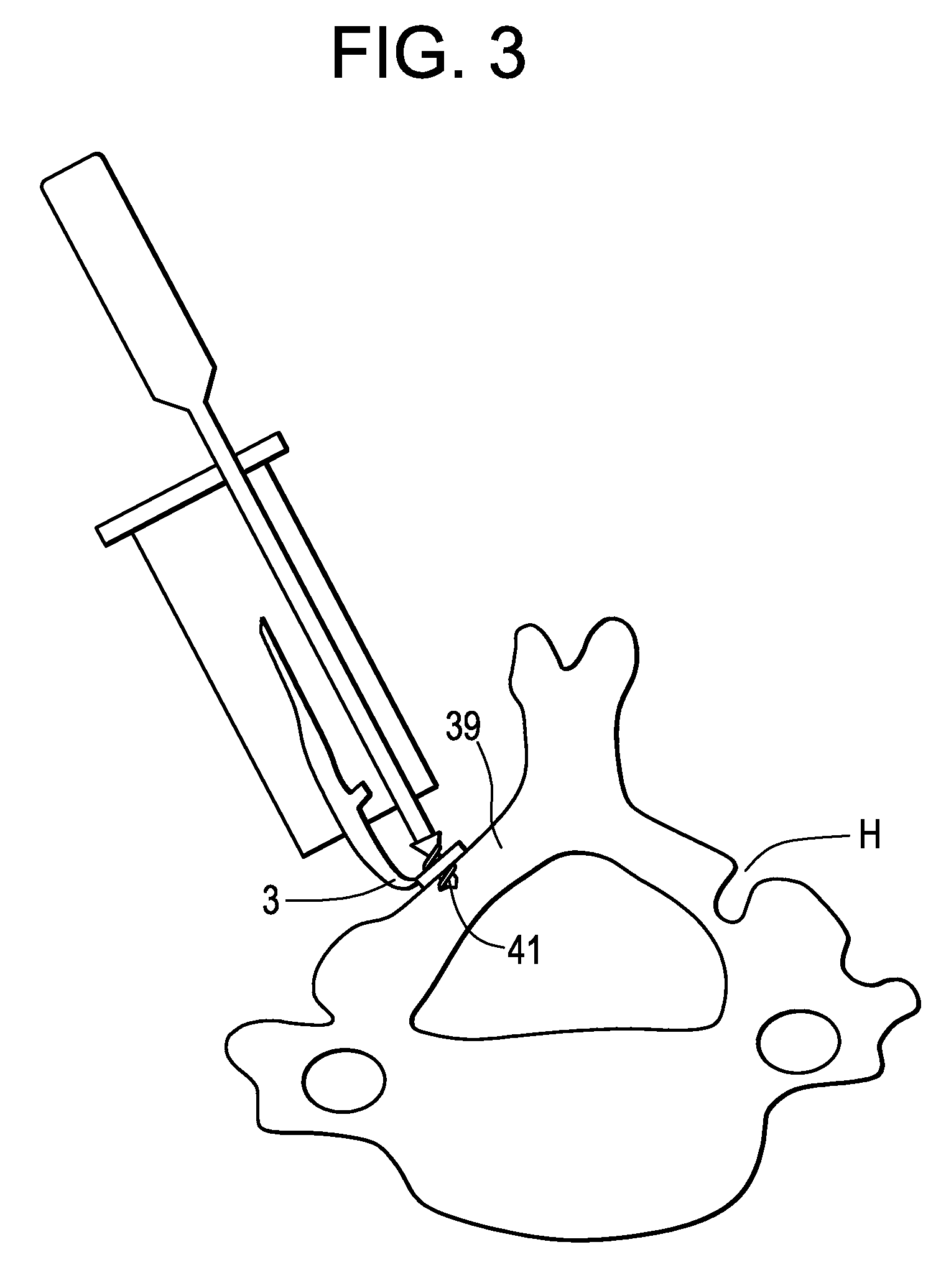 Methods and devices for expanding a spinal canal using balloons