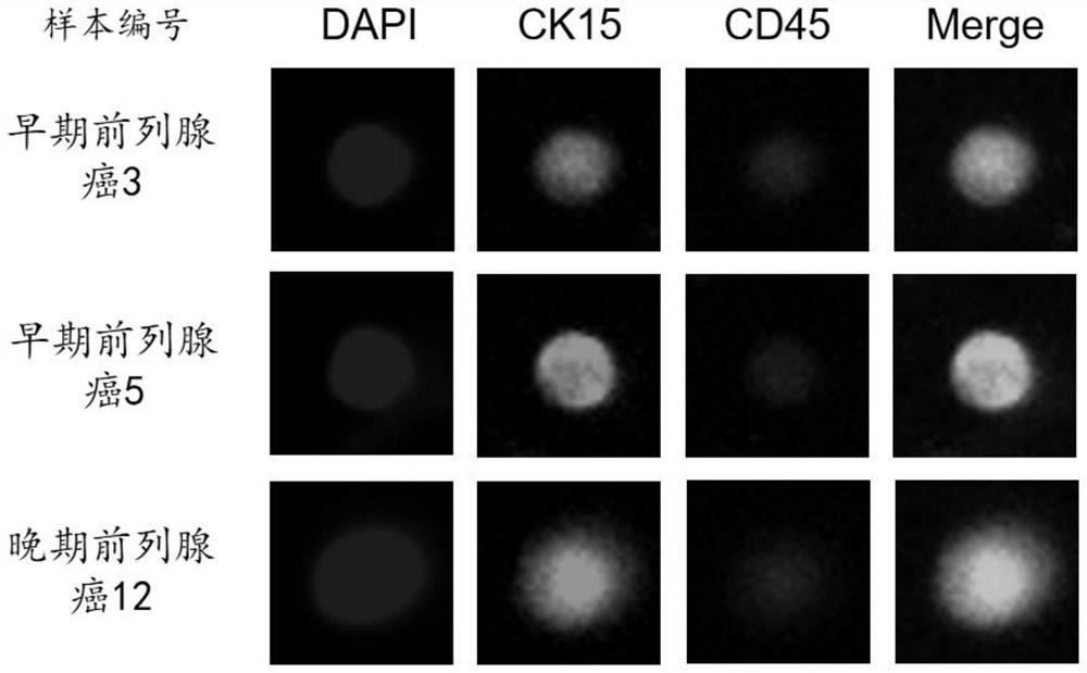 Immunofluorescence kit for detecting circulating prostate epithelial cells in blood and use method of immunofluorescence kit