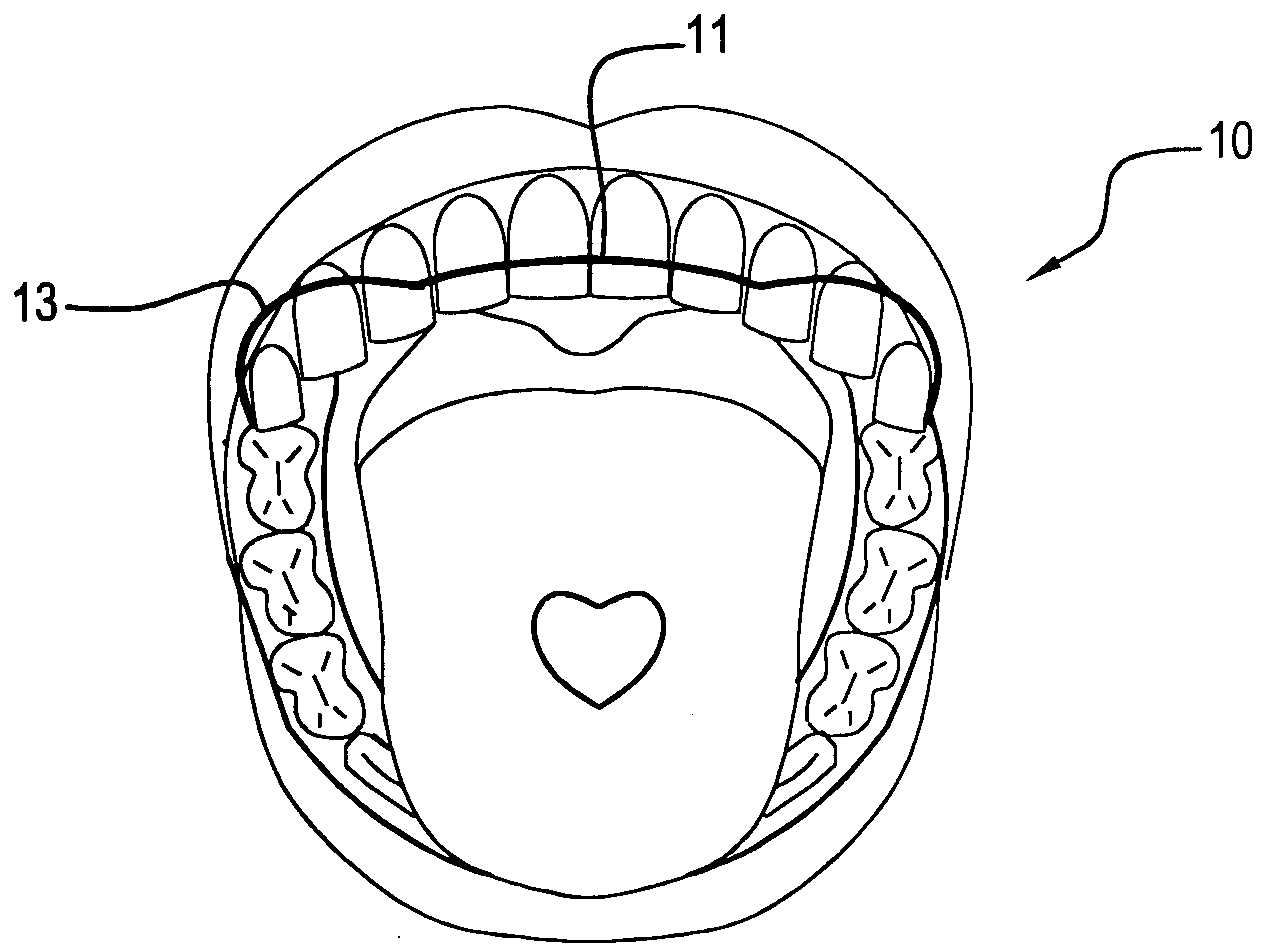 Illuminated orthodontic retainer