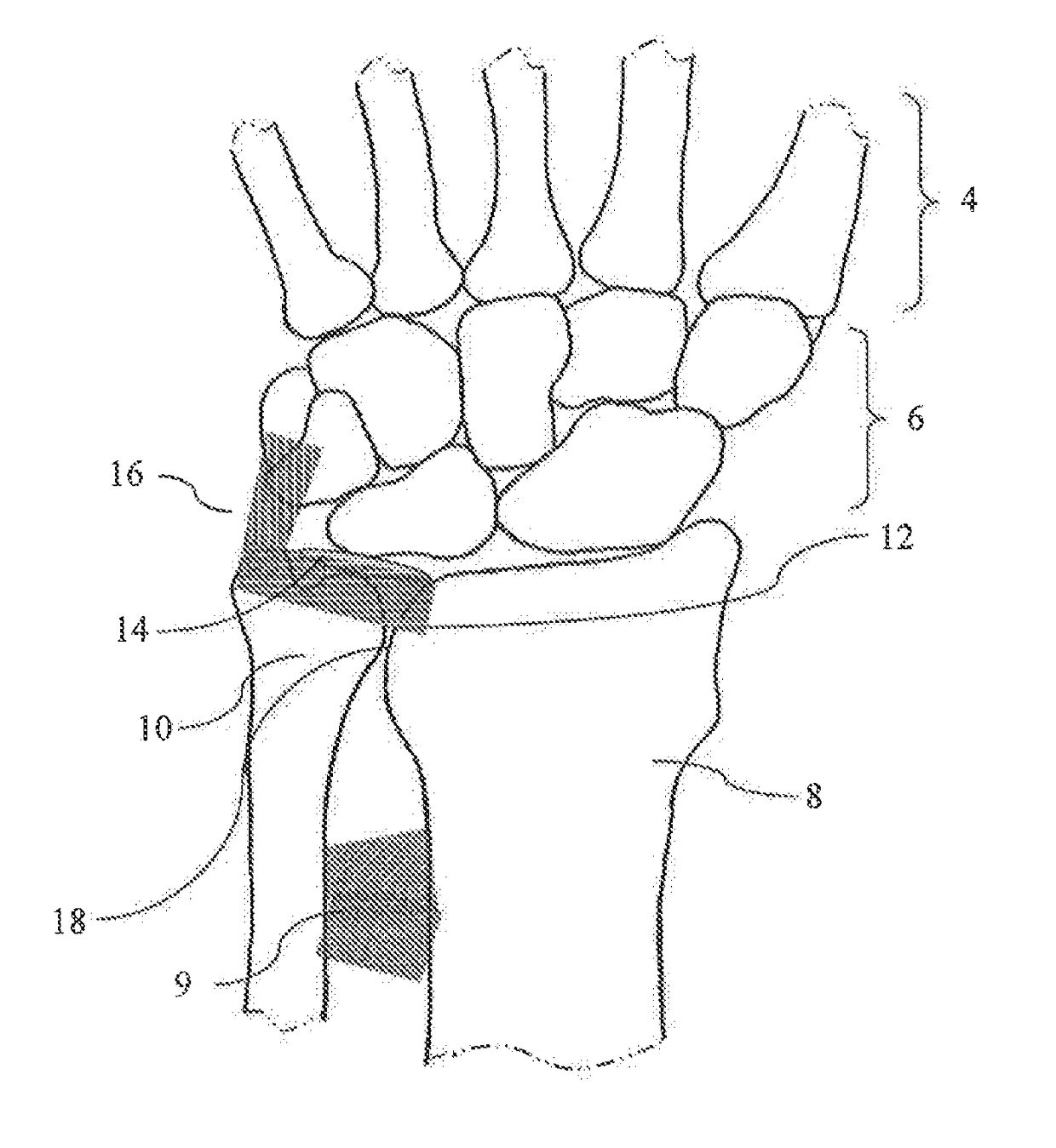 Distal Radioulnar Joint Prosthesis and Method of Use