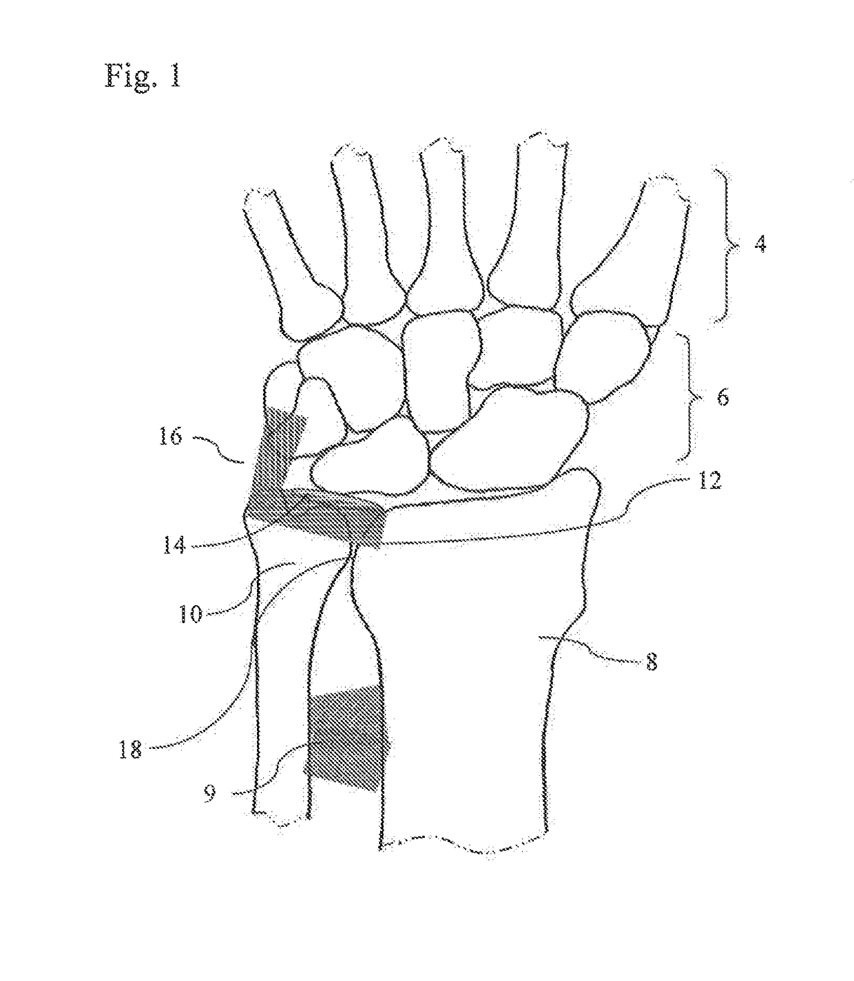 Distal Radioulnar Joint Prosthesis and Method of Use