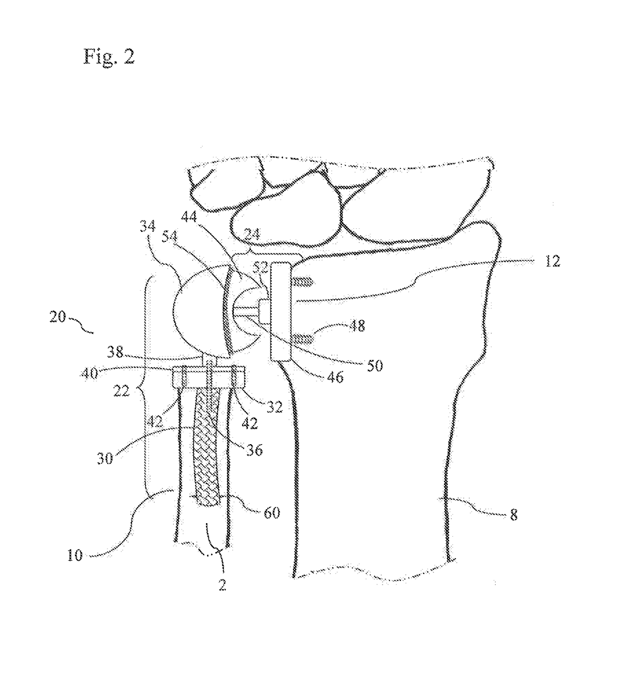 Distal Radioulnar Joint Prosthesis and Method of Use