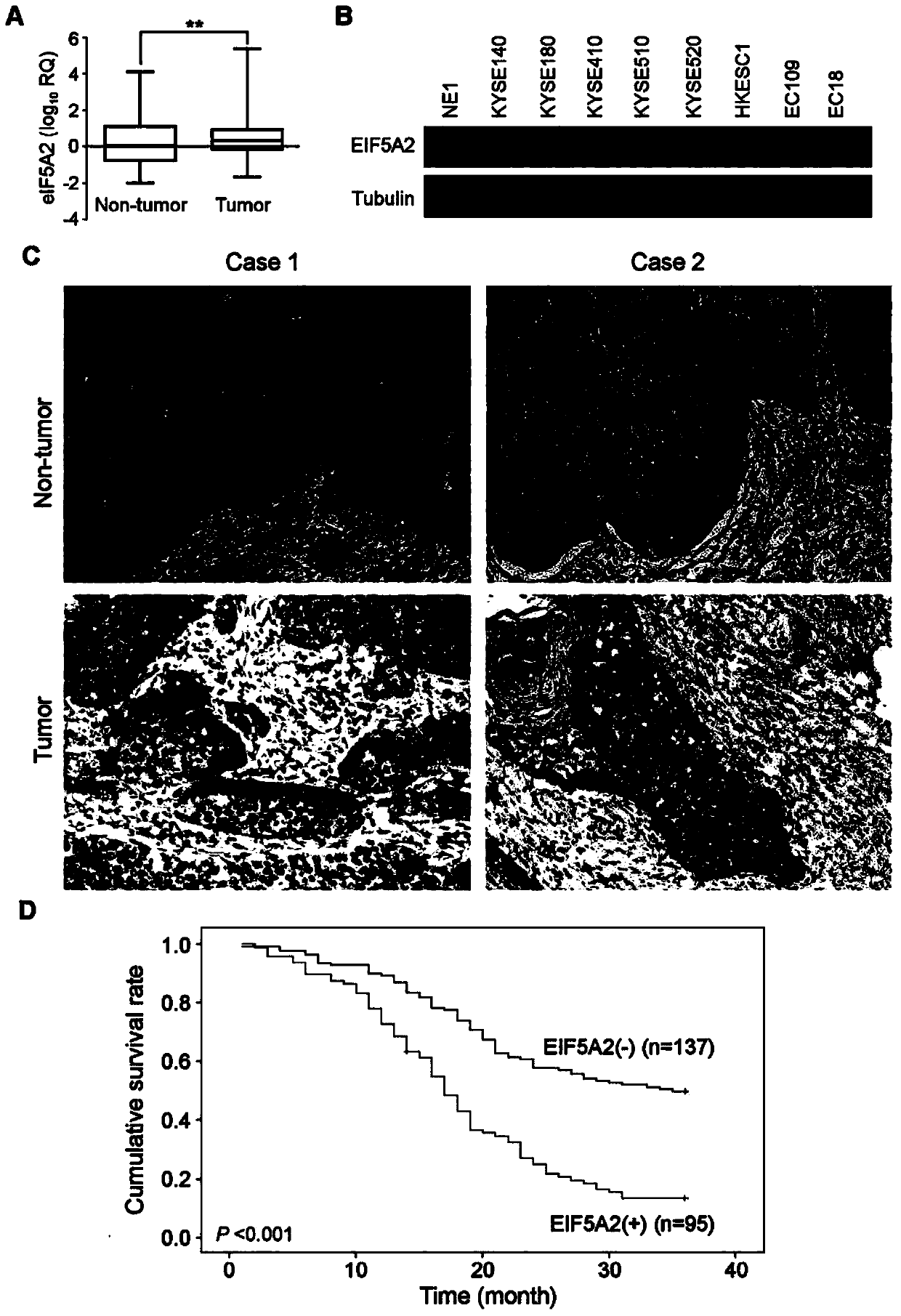 Application of EIF5A2 to preparation of esophageal squamous cell carcinoma prognosis reagent