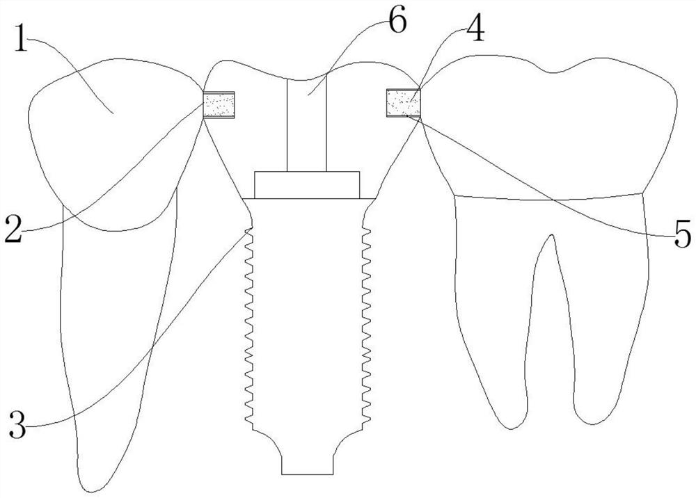 Method for solving dental implant impaction