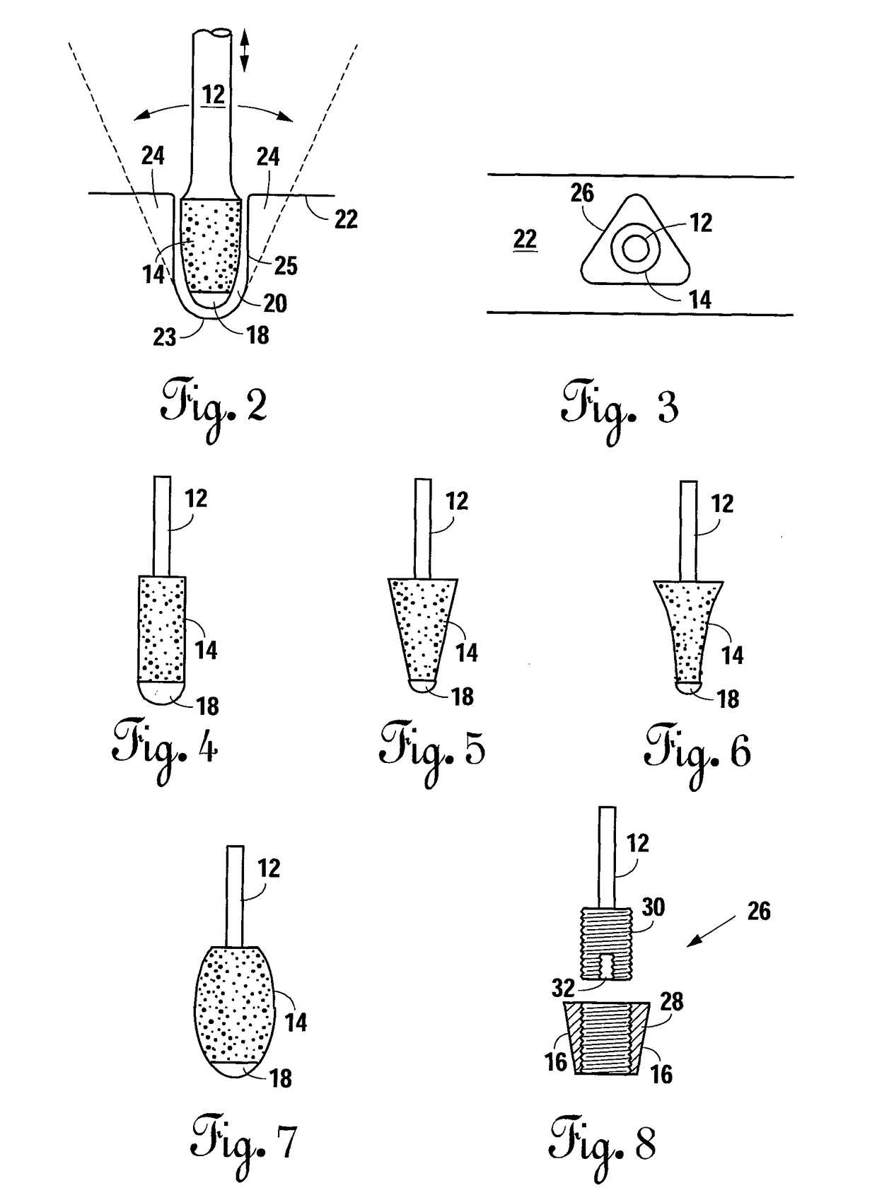 Methods and apparatus for preparing a dental implant site