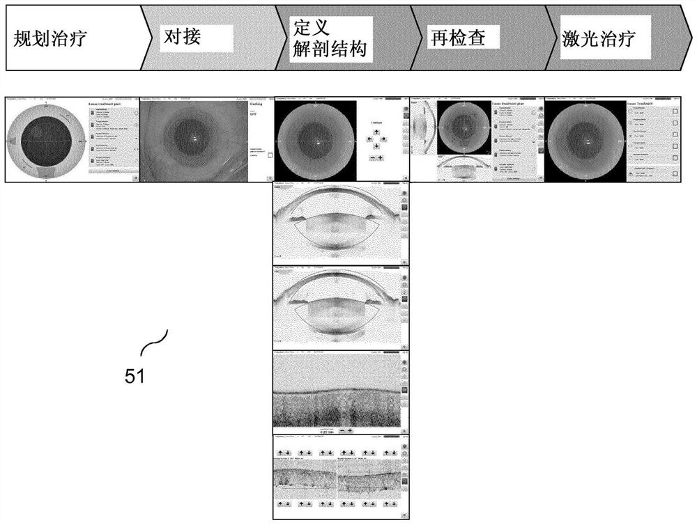 Systems and methods for laser assisted eye treatment