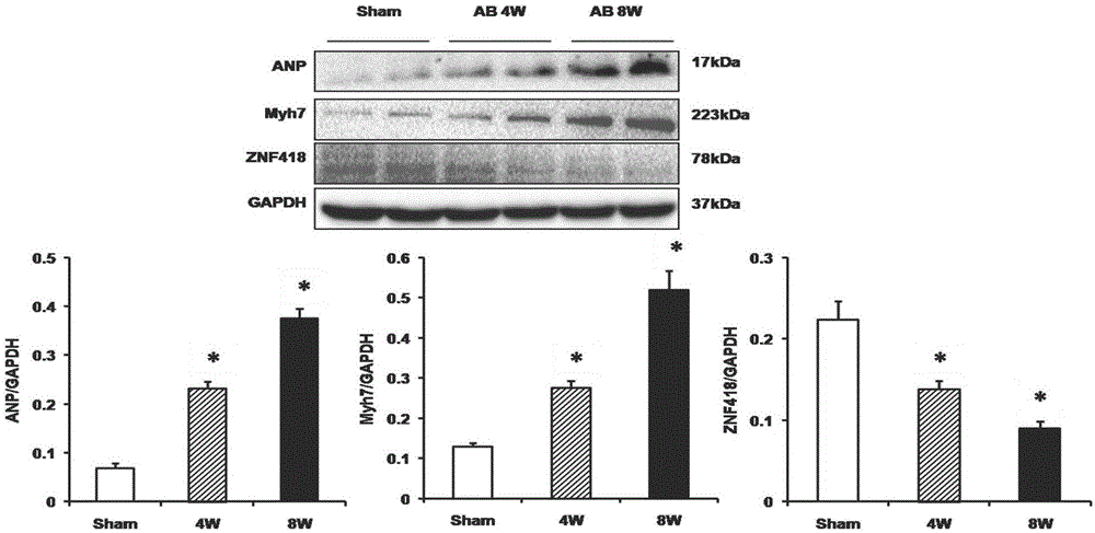 Application of ZNF418 (zinc finger protein 418) to treatment of myocardial hypertrophy