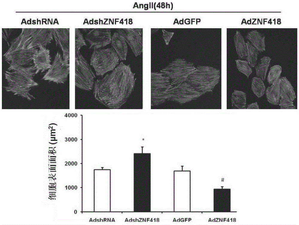 Application of ZNF418 (zinc finger protein 418) to treatment of myocardial hypertrophy