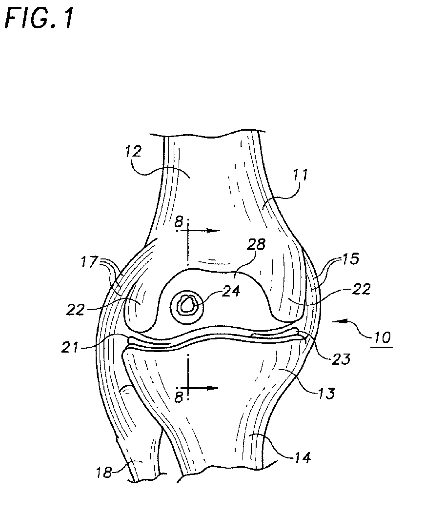 Method and apparatus for harvesting and implanting bone plugs