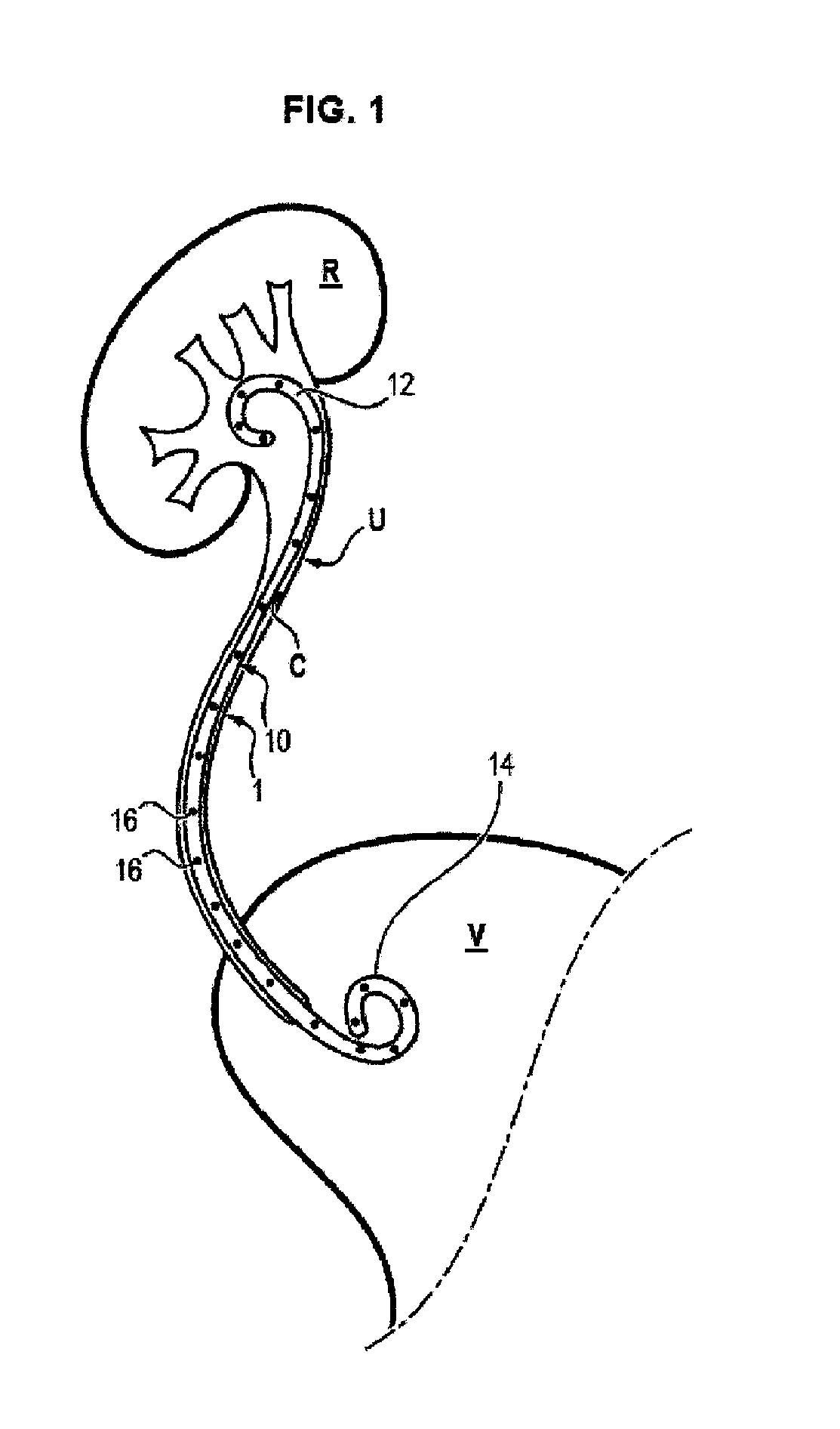 Improved ureteral stent and method for treating urological problems