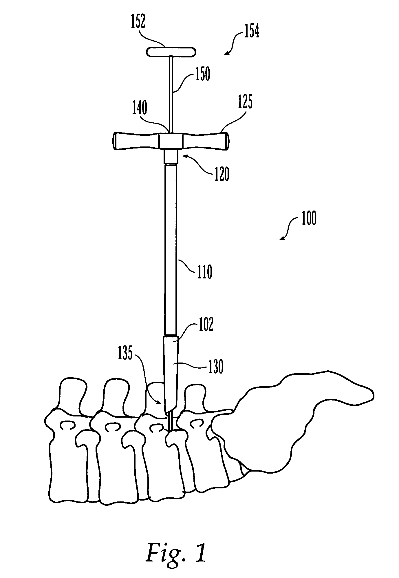 Less invasive surgical system and methods