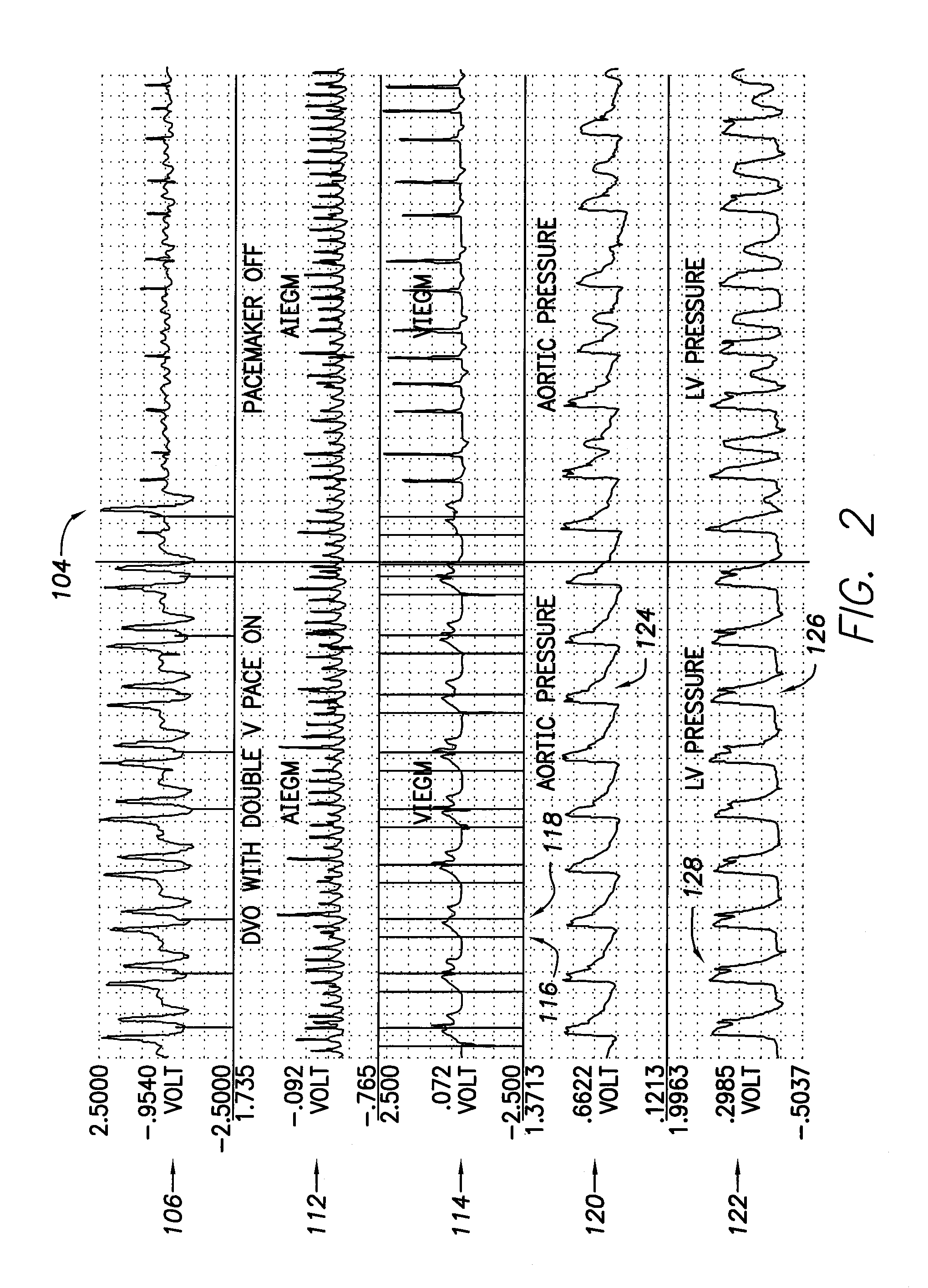 Systems and methods for paired/coupled pacing and dynamic overdrive/underdrive pacing